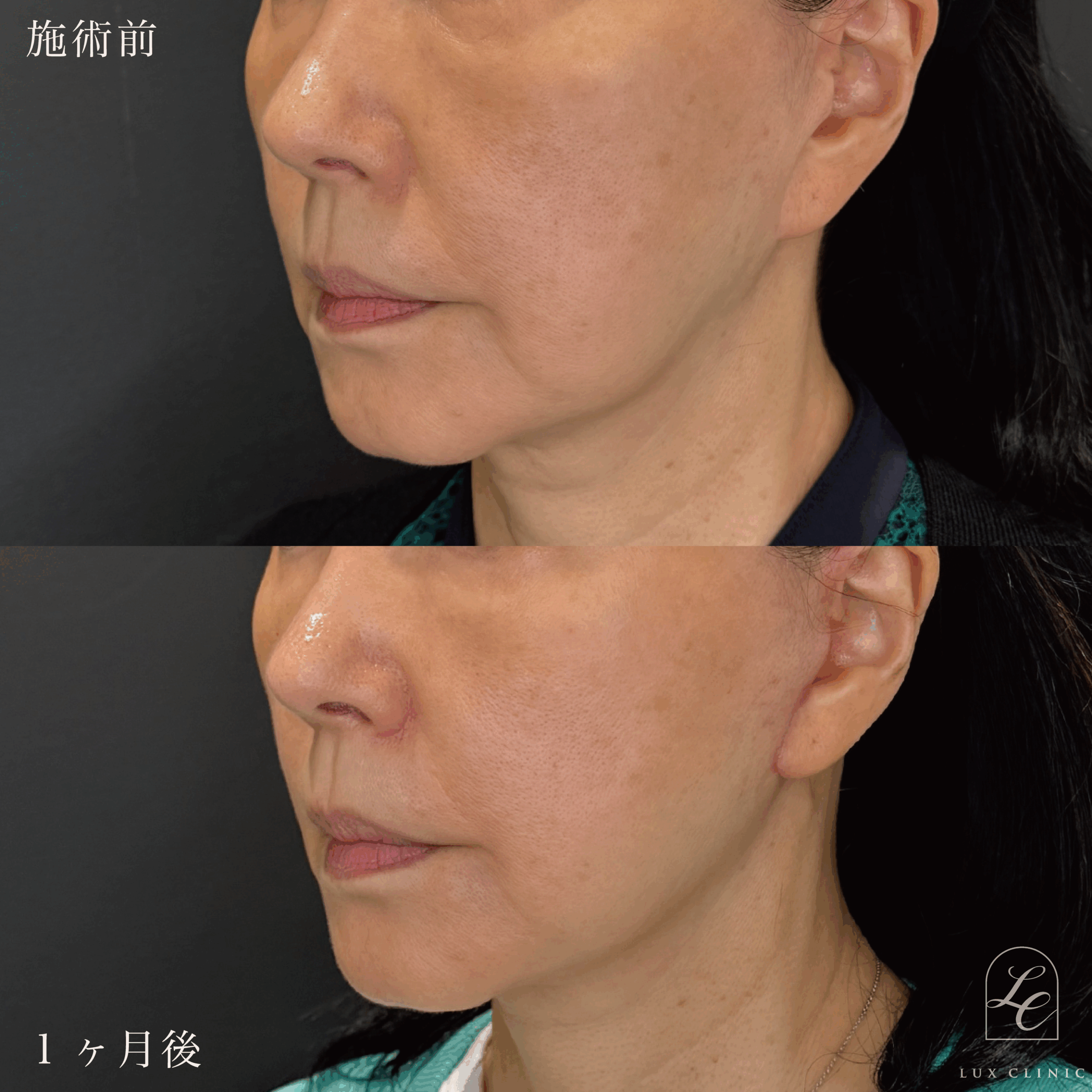 ミニフェイスリフト