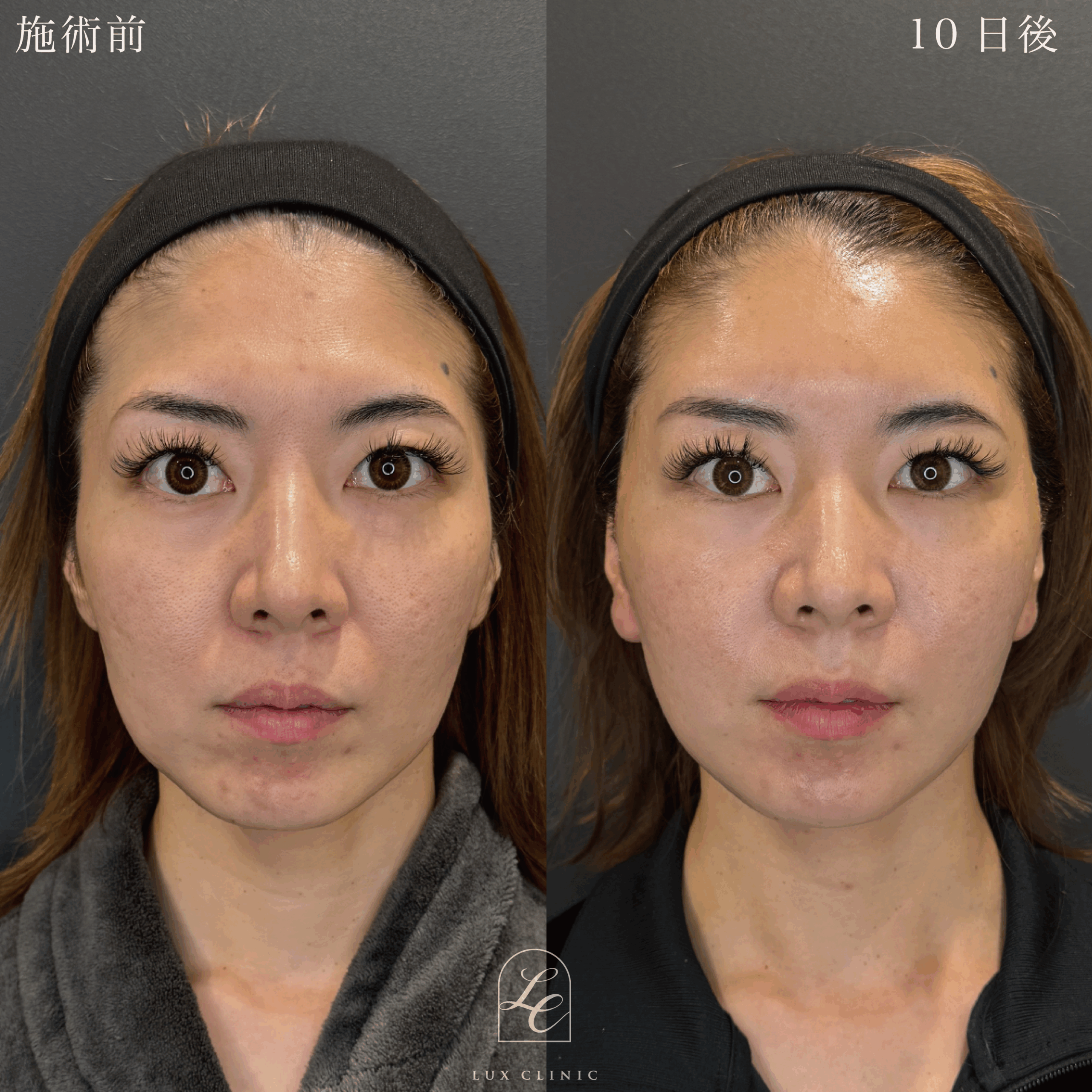 ミニフェイスリフト ＋ もみあげリフト ＋コンデンスリッチ脂肪注入 ＜顔全体・首＞ ※顔出しモニター