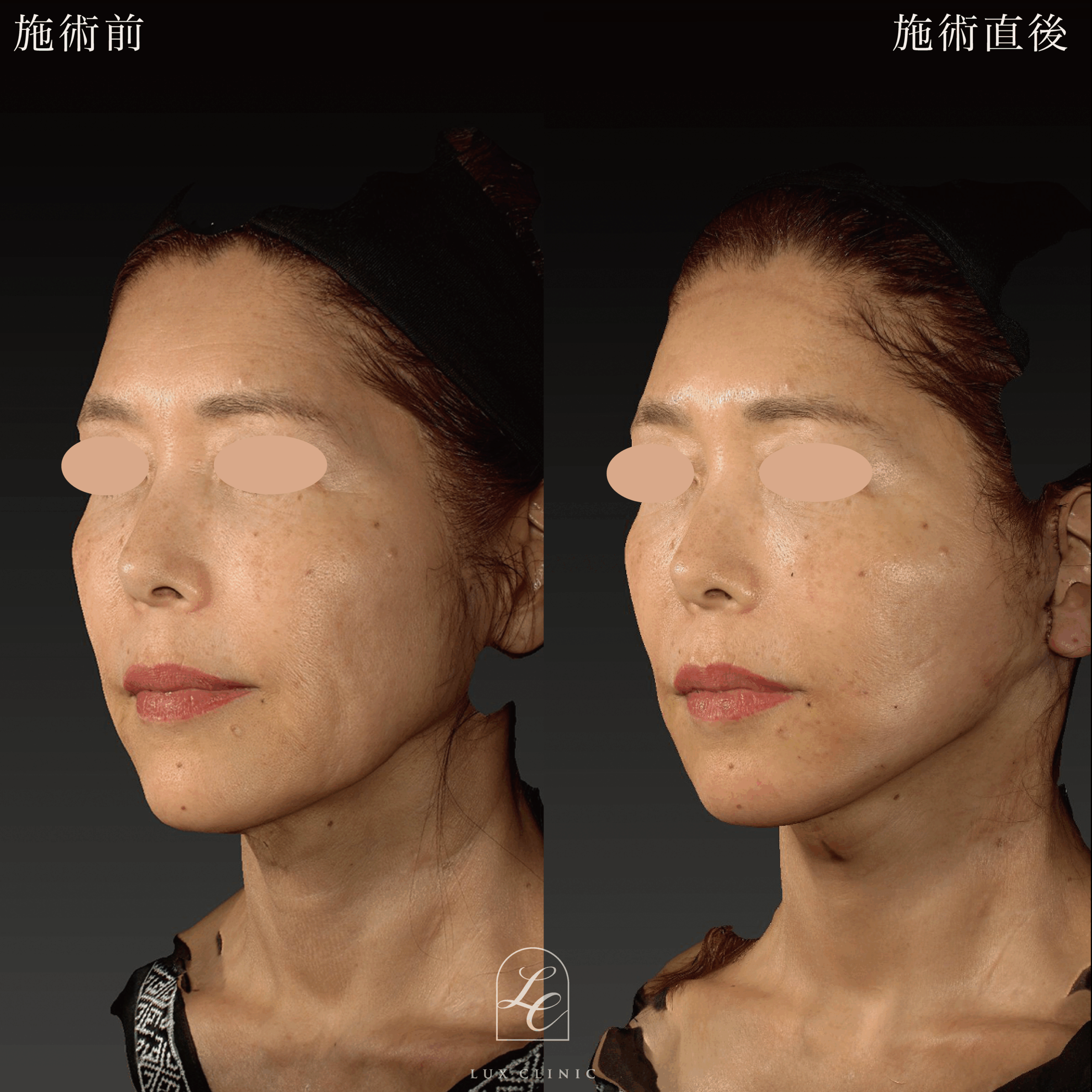 ミニフェイスリフト ヒアルロン酸（レスチレン2本）＜口横＞