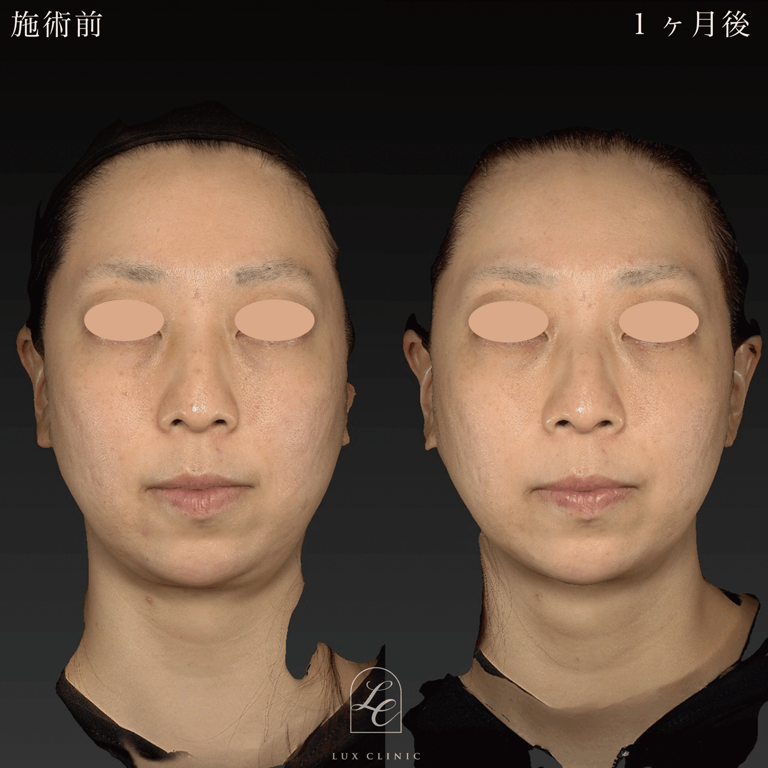 インモードVリフト（miniFX＋FORMA）1 回