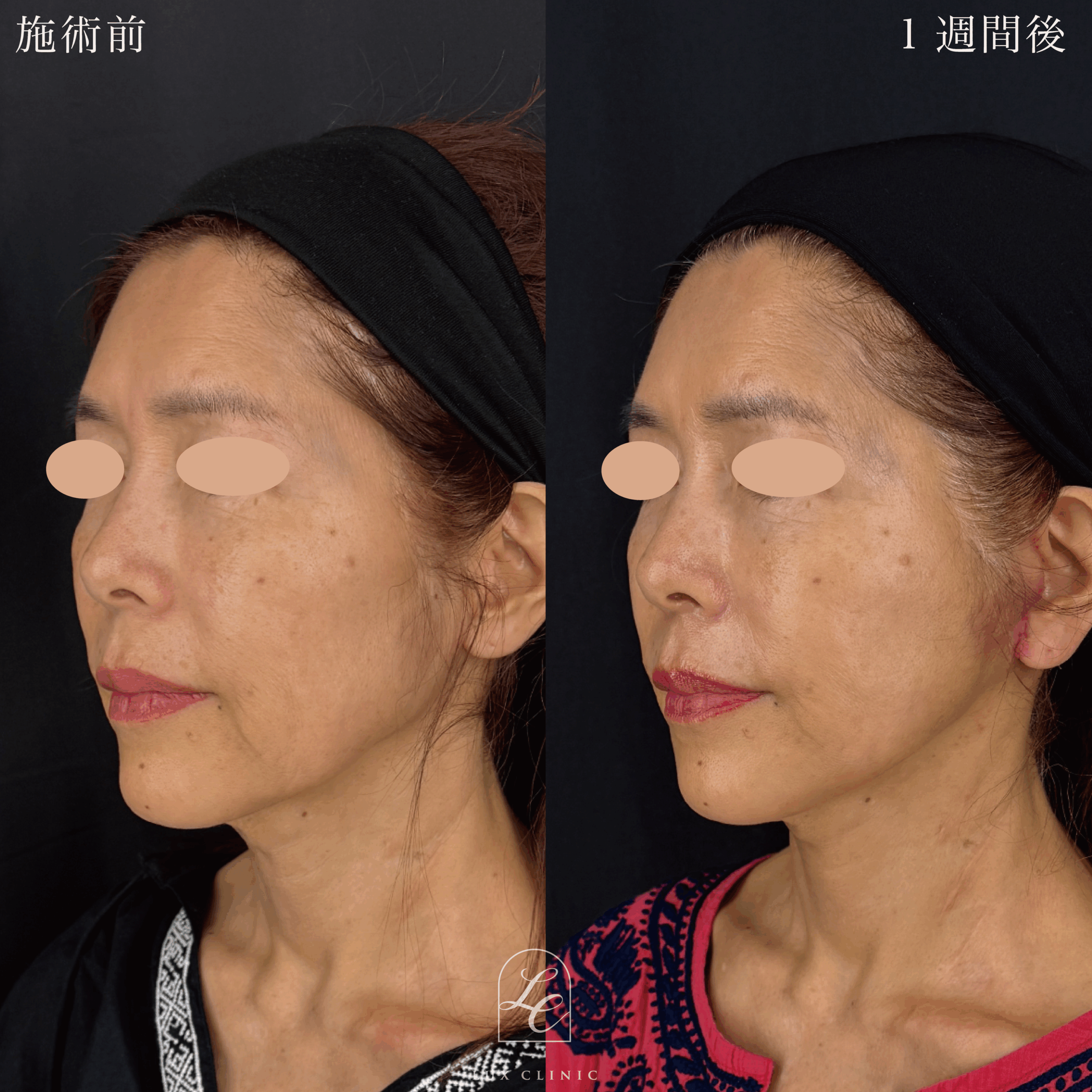 ミニフェイスリフト ＋ ヒアルロン酸（レスチレン4本）＜口横＞