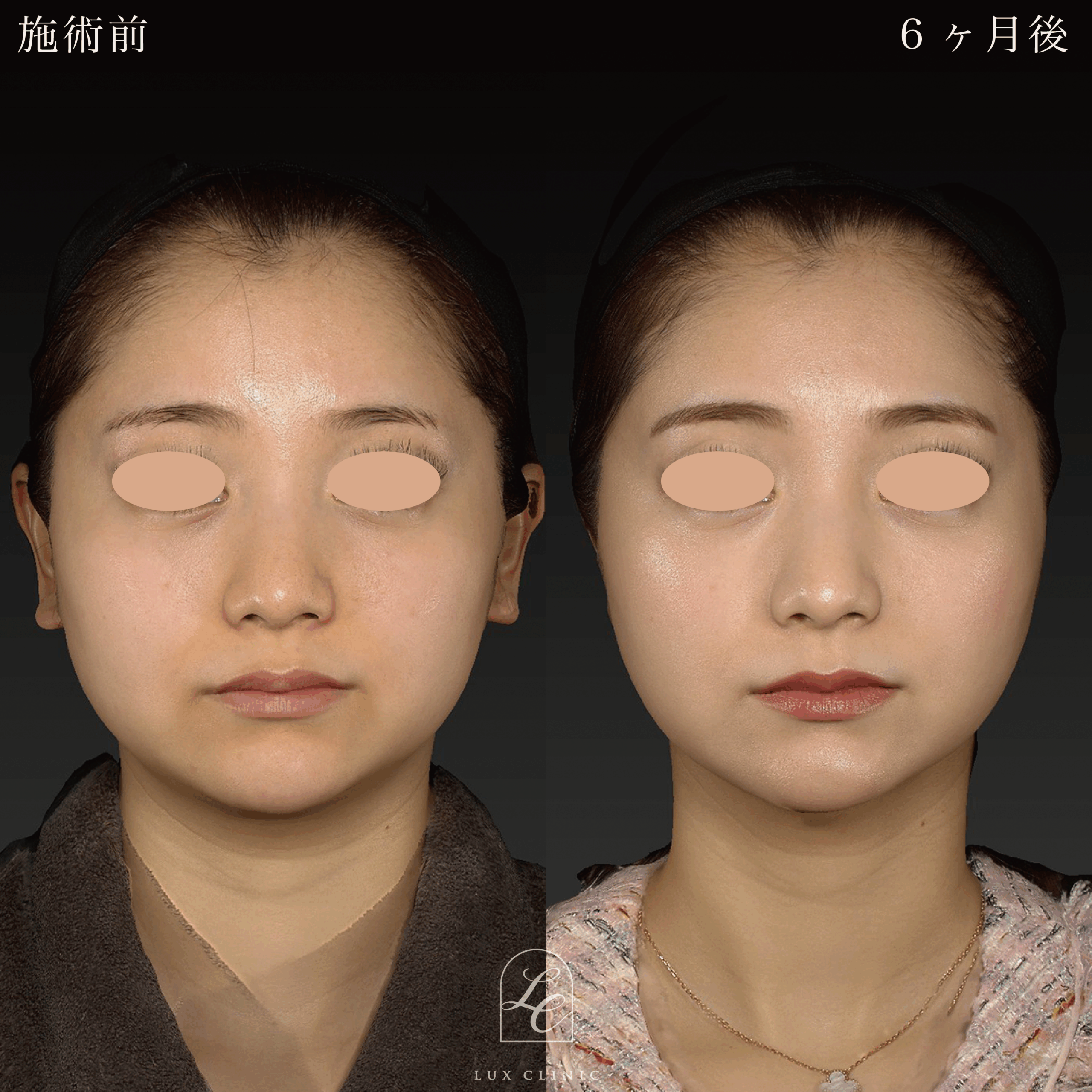 Ultra-Z 脂肪吸引＜あご下＞＋ 糸リフト（テスリフト 4本・BNLS Ultimate Lifting 2本）