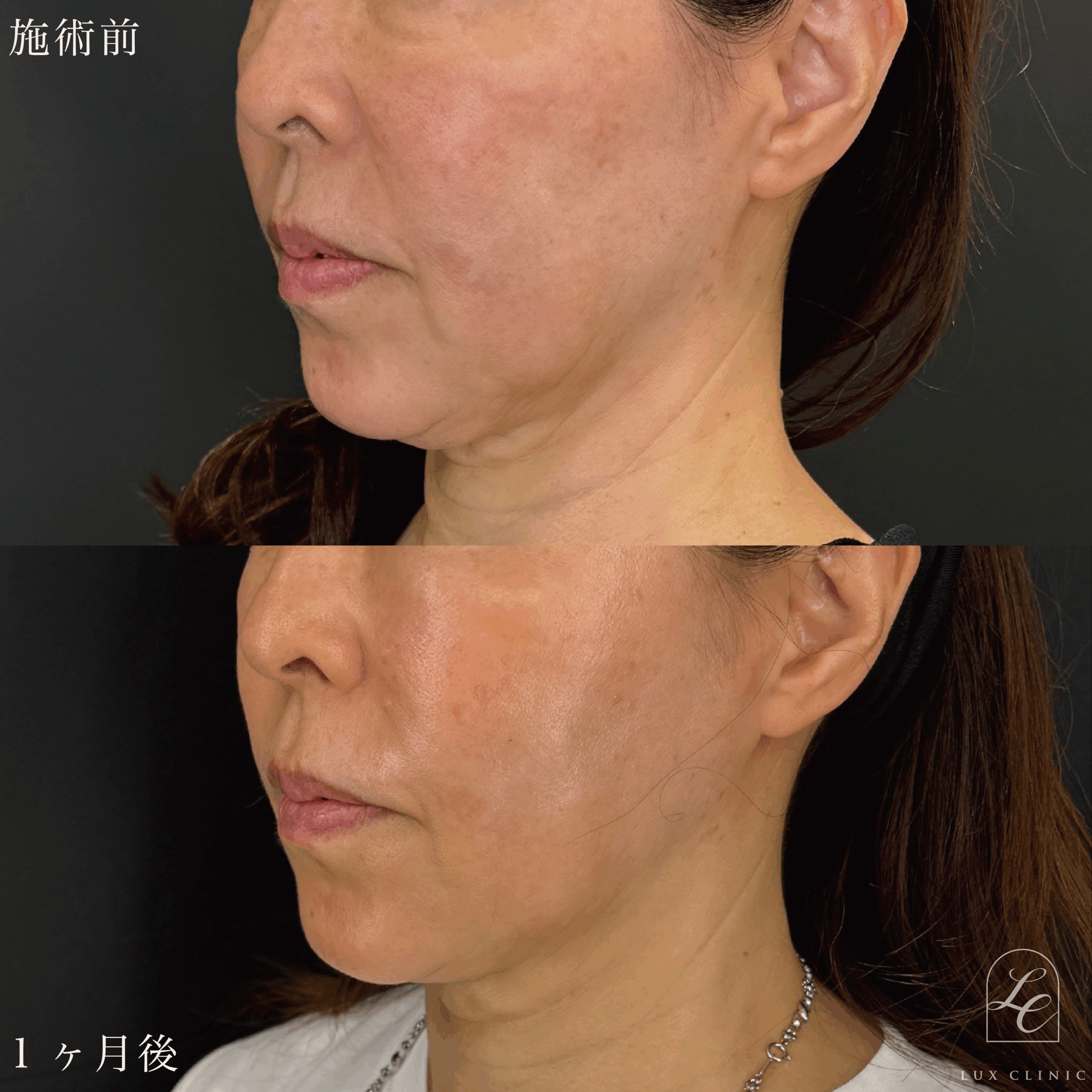 糸リフト（テスリフト 6本・BNLS Ultimate Lifting 4本）　+　ヒアルロン酸（ニューラミス）2本＜頬・ほうれい線＞