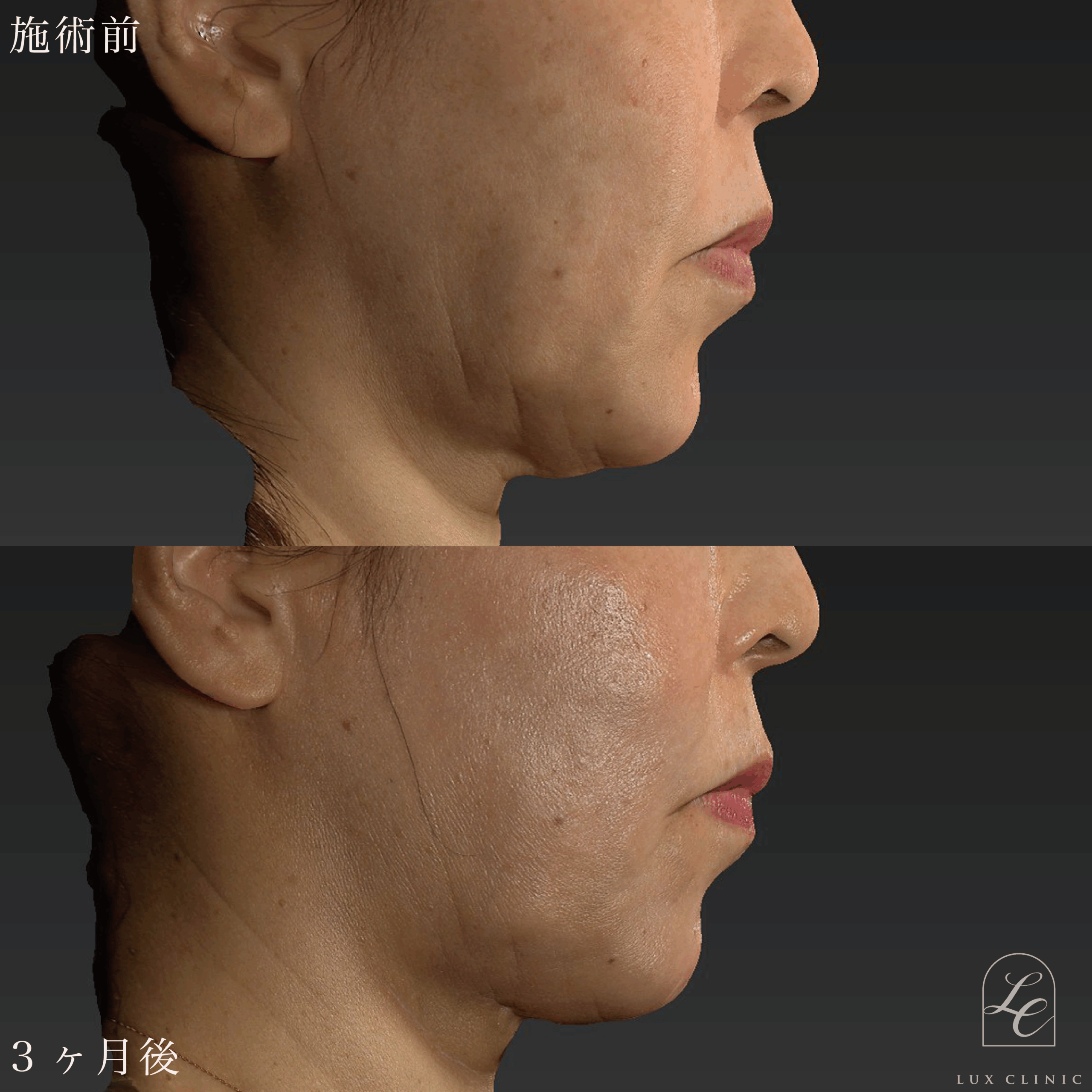 糸リフト（テスリフト 6本・BNLS Ultimate Lifting 4本）＋ヒアルロン酸（ニューラミス 2本）＜頬・ほうれい線＞