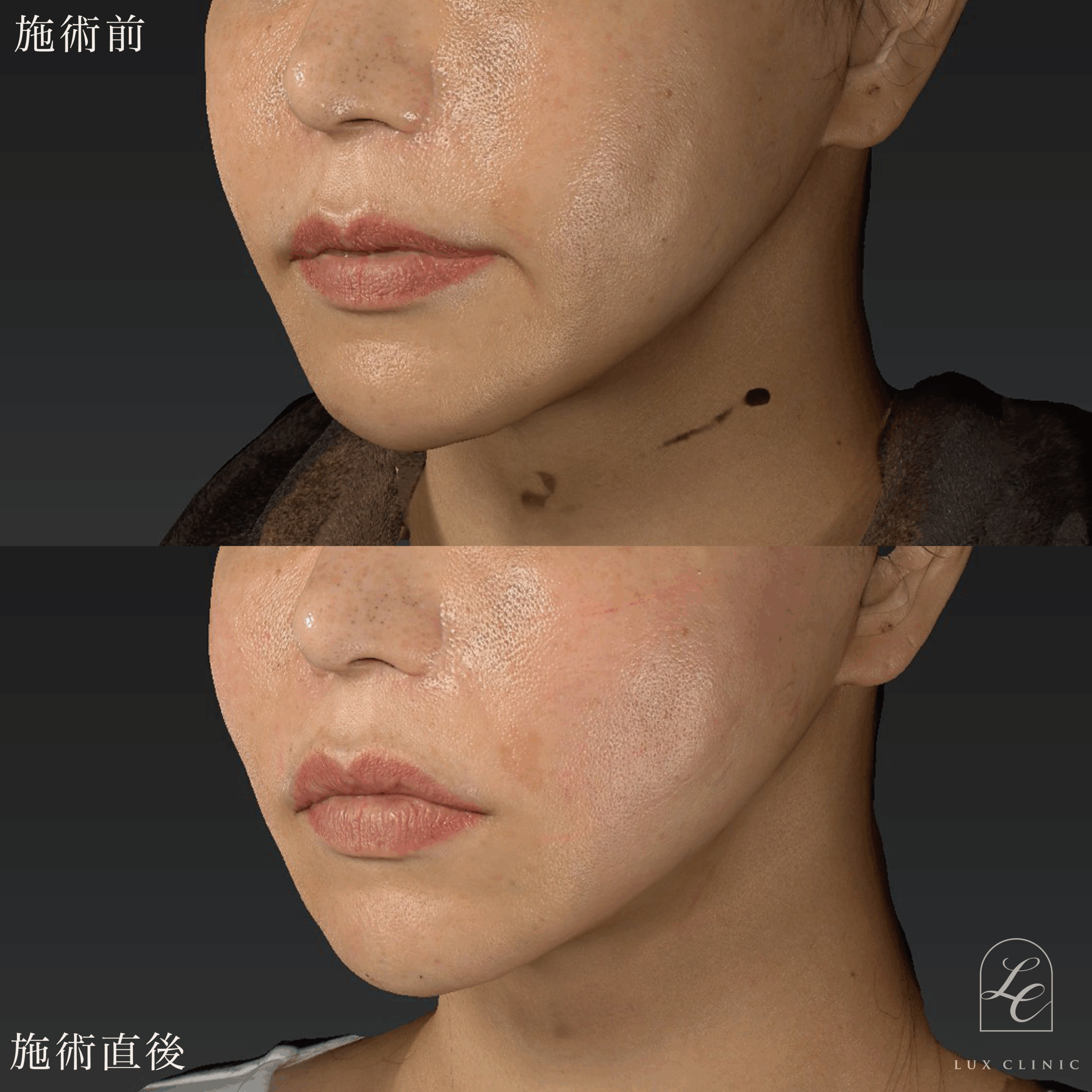 糸リフト(テスリフト 4本・フィオラスレッドFL 4本)