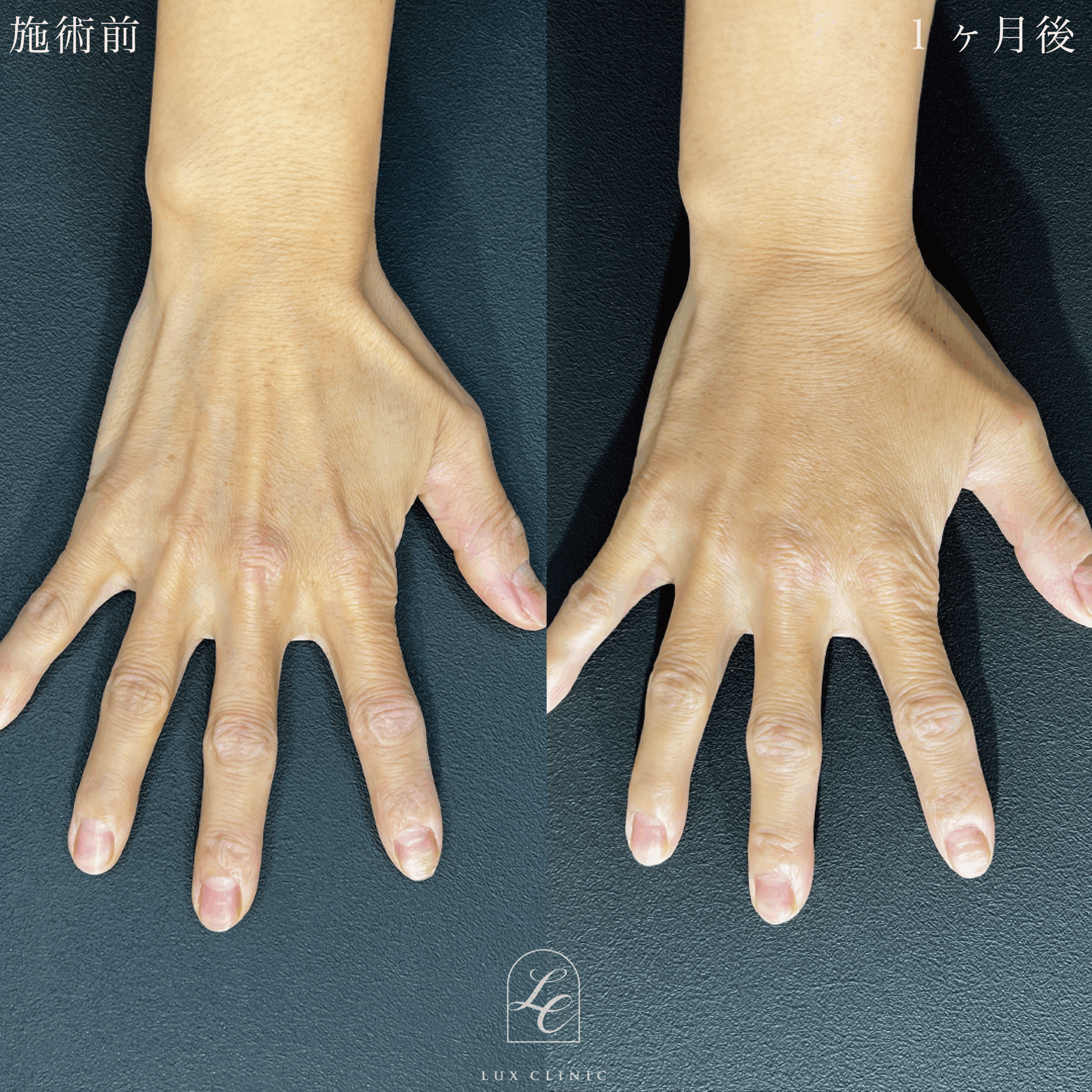 コンデンスリッチ脂肪注入 ＜手の甲＞