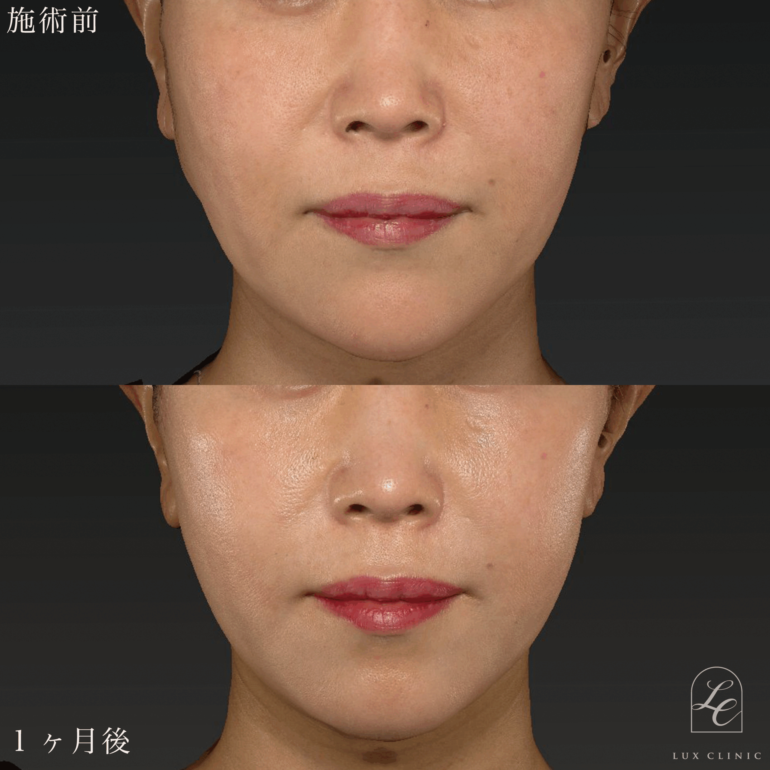 もみあげリフト ＋ ヒアルロン酸（レスチレン2本）＜顔全体ちらし入れ＞※顔出しモニター