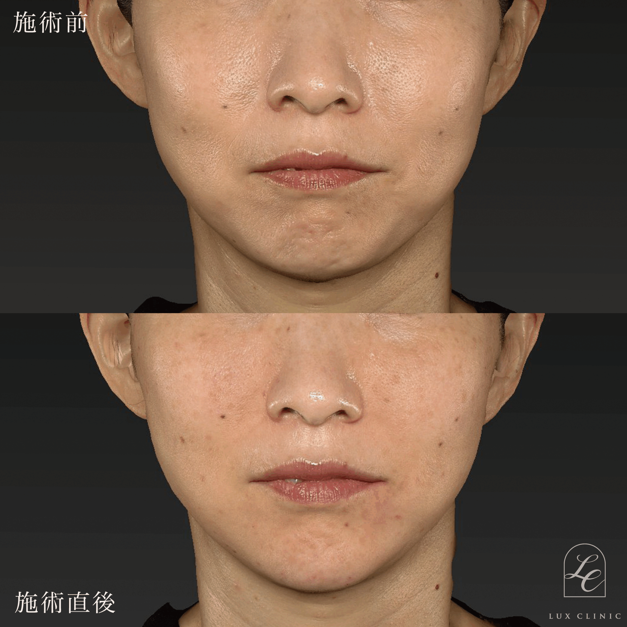 ヒアルロン酸（レスチレン 5本）＜頬、マリオネットライン、顎角、こめかみ＞