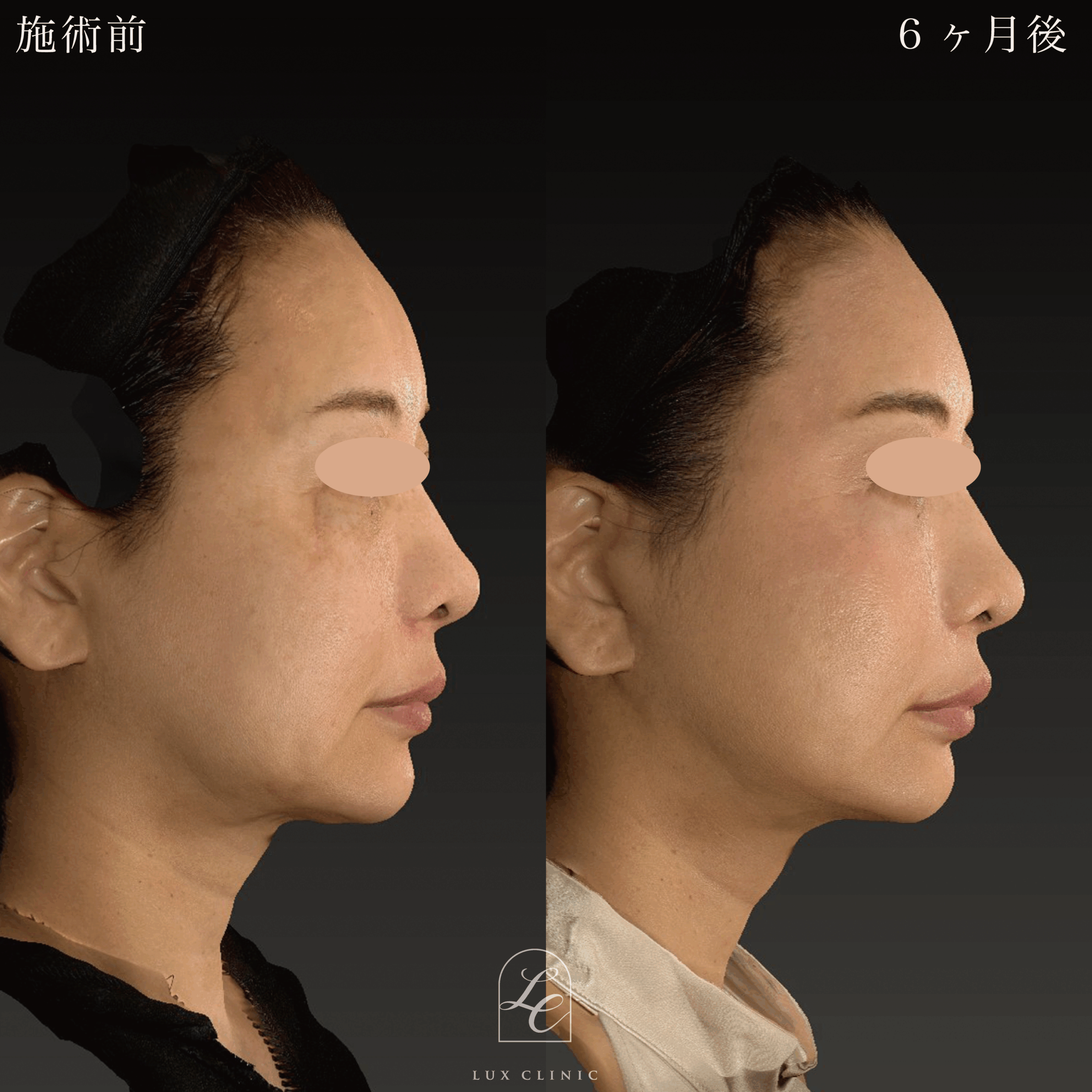 ミニフェイスリフト ＋ 糸リフト 10本