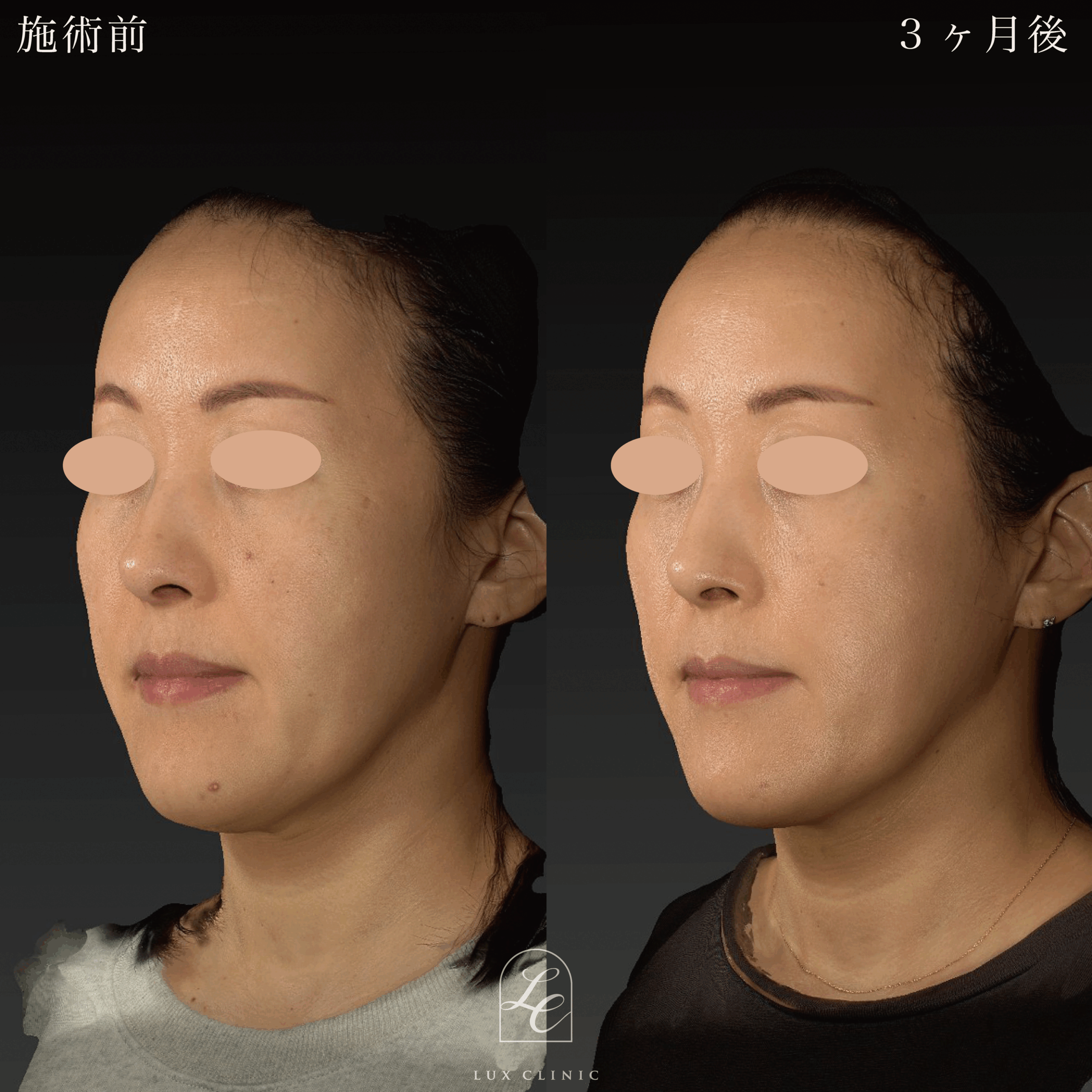 もみあげリフト