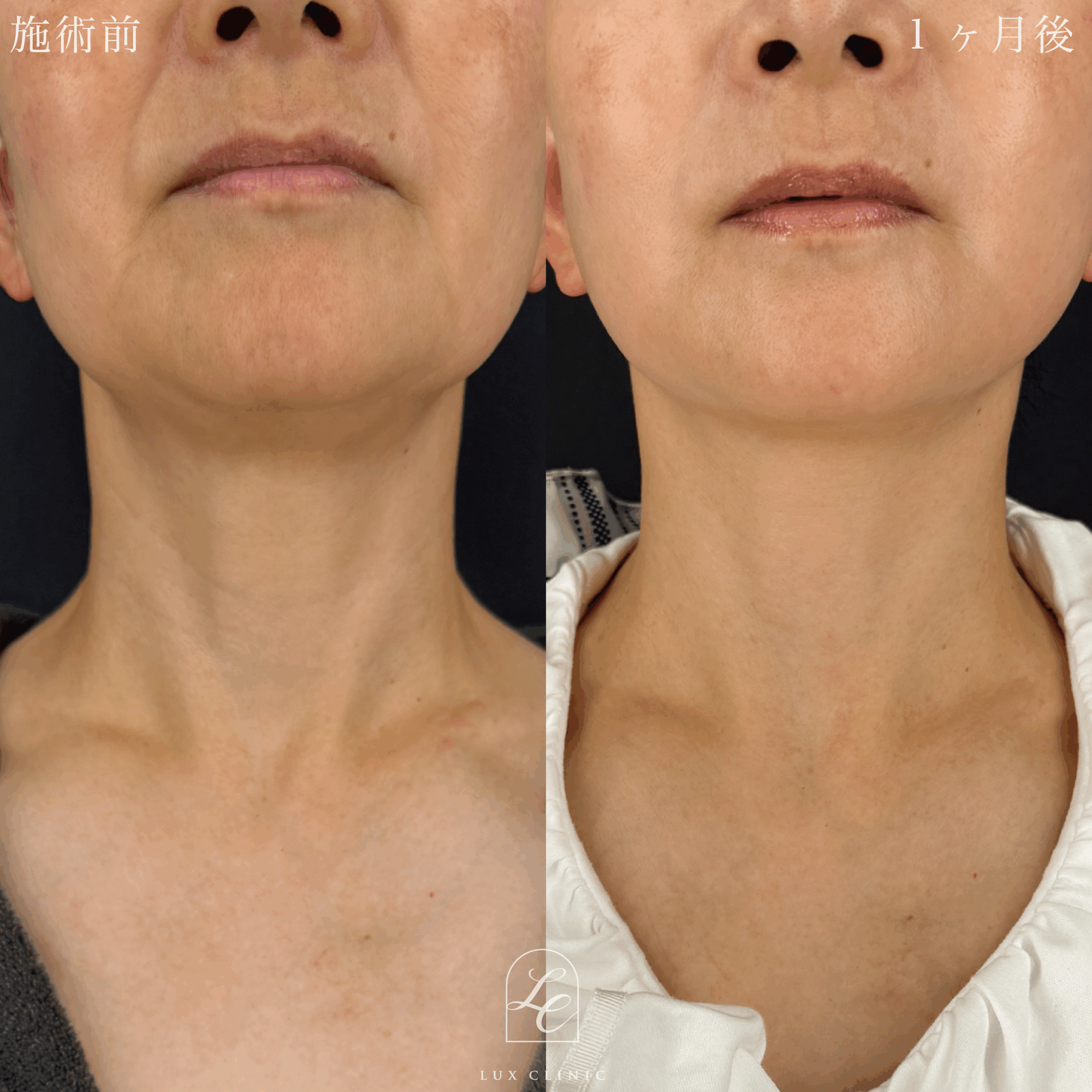 ディーププレーンフェイスネックリフト ＋ もみあげリフト ＋ コンデンスリッチ脂肪注入 ＜顔全体・首＞