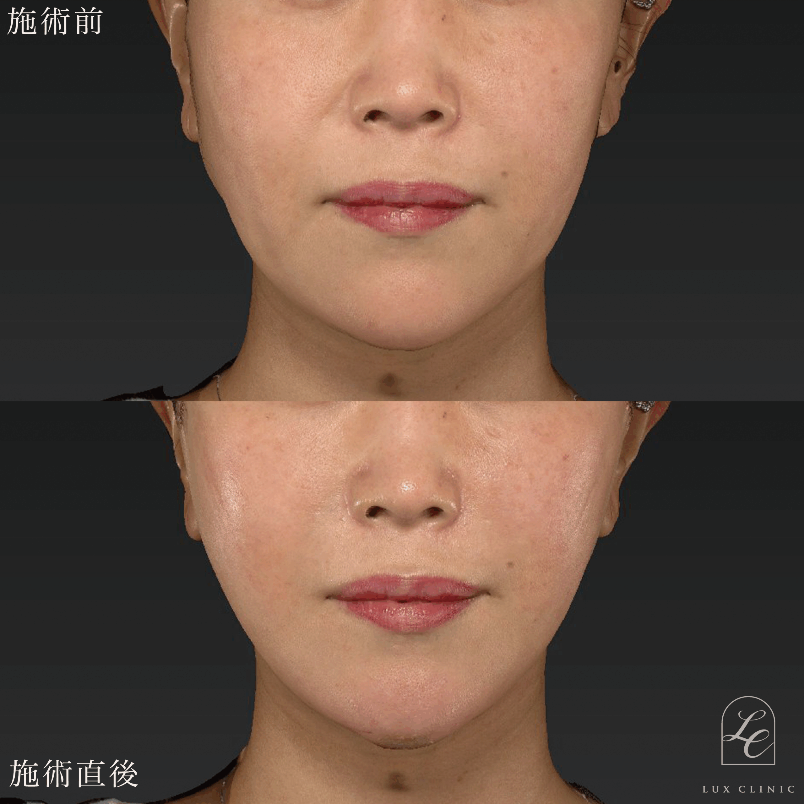 もみあげリフト ＋ ヒアルロン酸（レスチレン2本）＜顔全体ちらし入れ＞