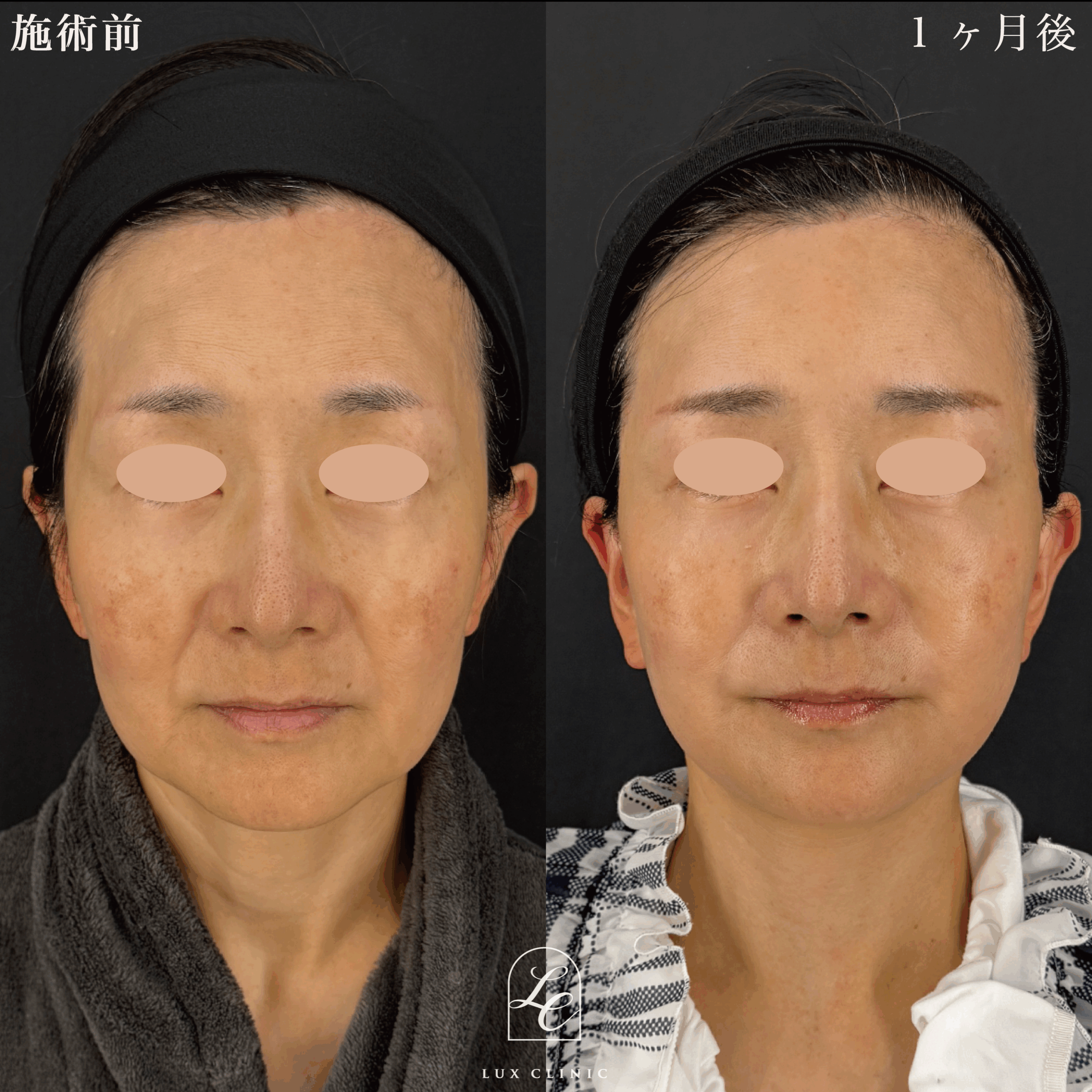 ディーププレーンフェイスネックリフト ＋ もみあげリフト ＋ コンデンスリッチ脂肪注入 ＜顔全体・首＞