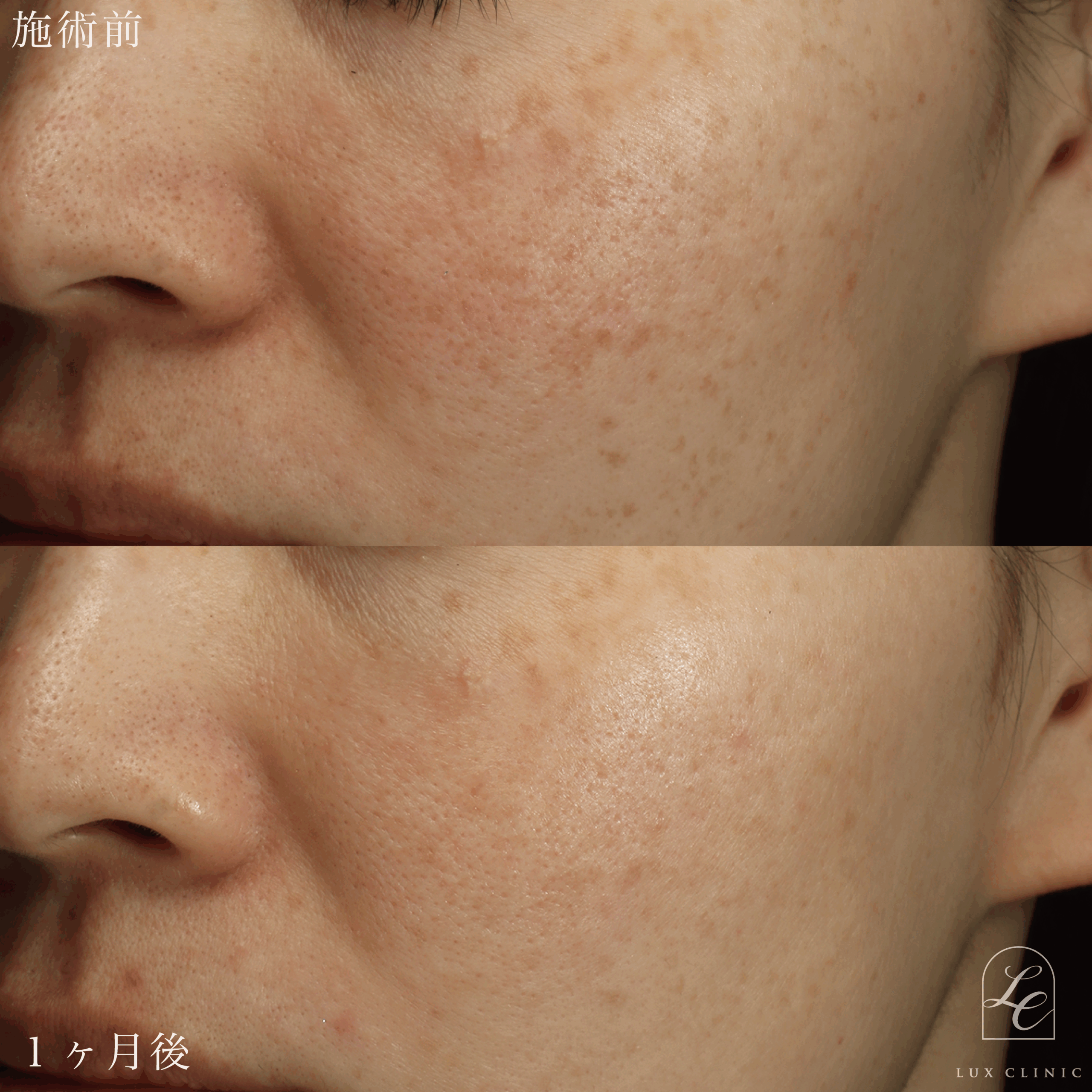 光治療IPL ルメッカ 1回