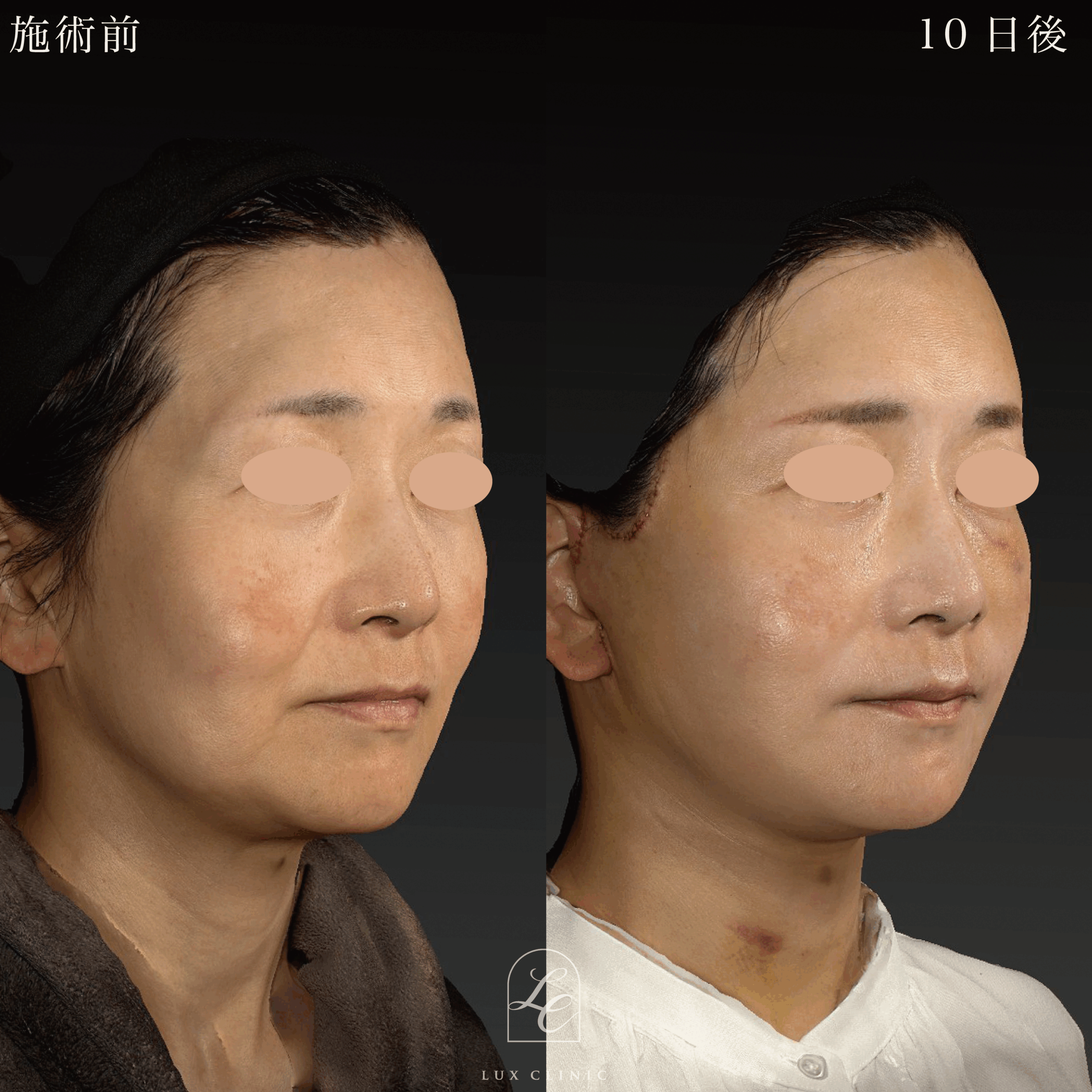 ディーププレーンフェイスネックリフト ＋ もみあげリフト ＋ コンデンスリッチ脂肪注入 ＜顔全体・首＞