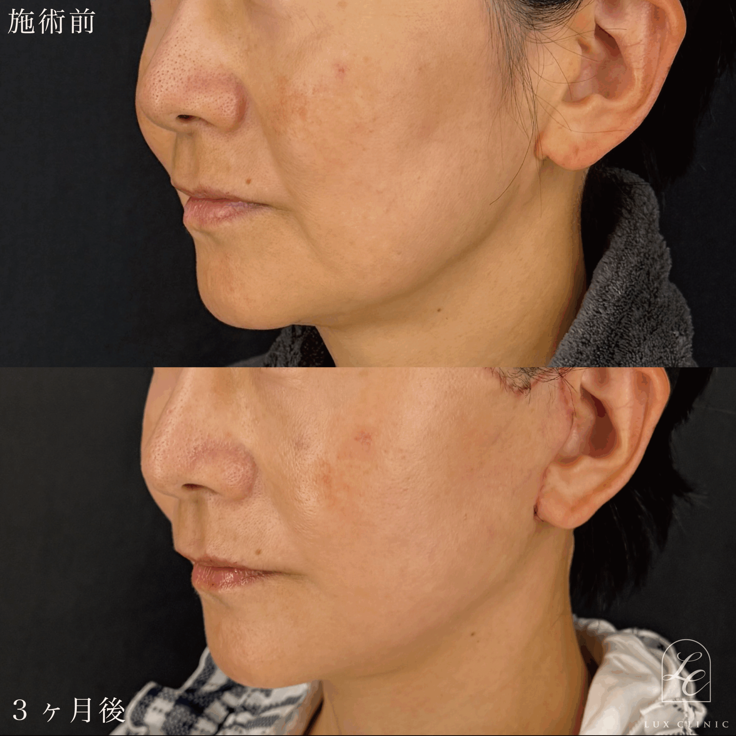 ディーププレーンフェイスネックリフト ＋ もみあげリフト ＋ コンデンスリッチ脂肪注入 ＜顔全体・首＞