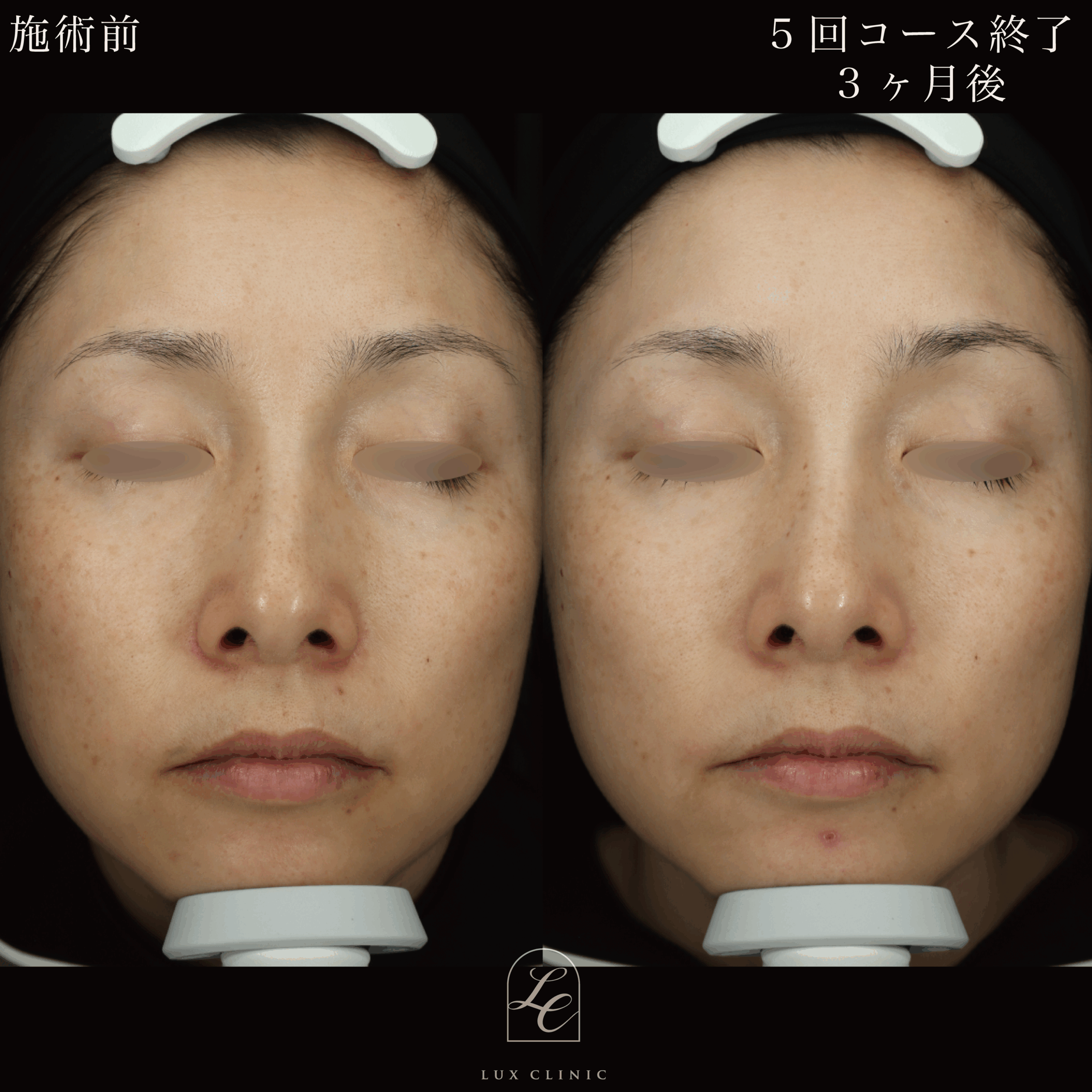 ディスカバリーピコプラス ピコトーニング 5回