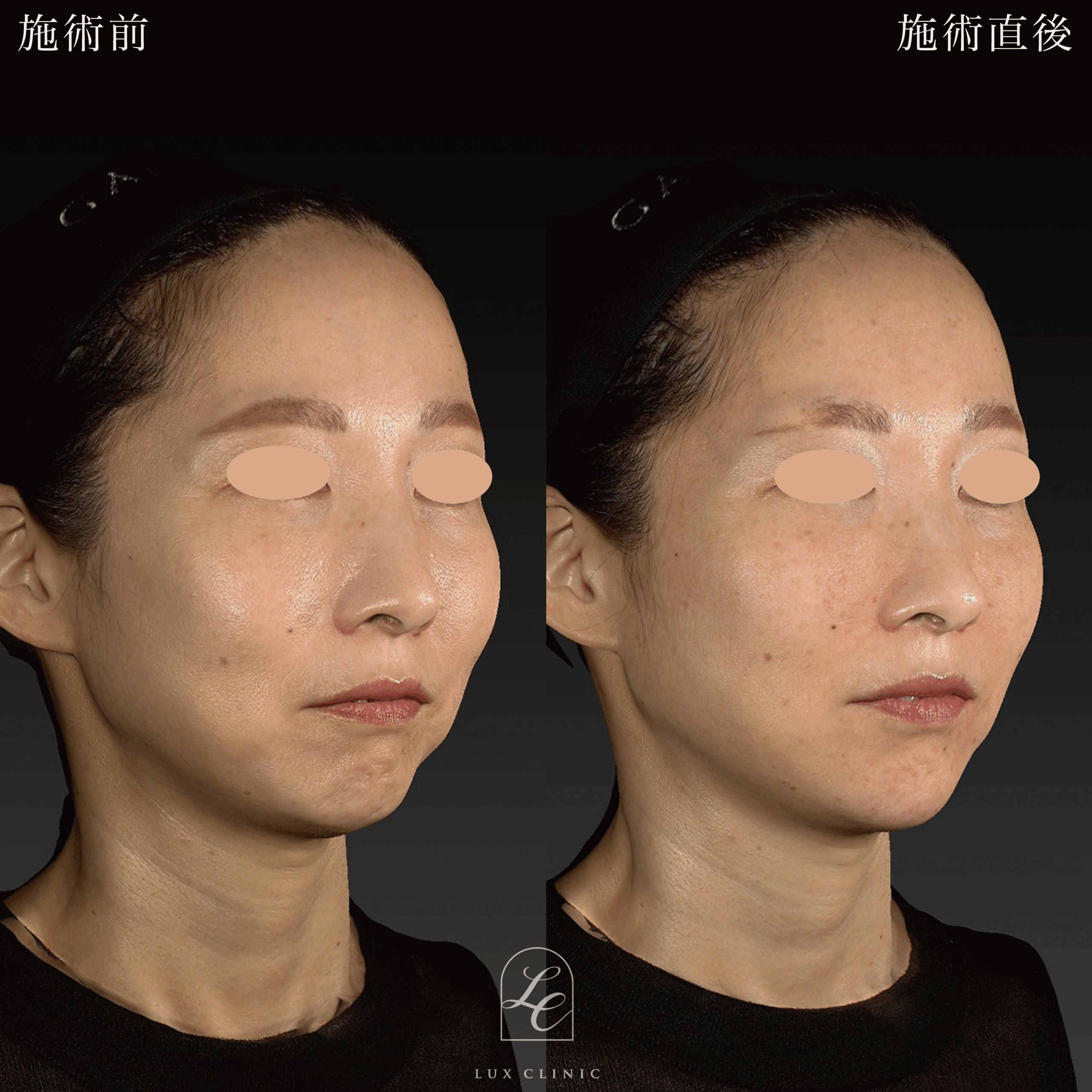 ヒアルロン酸（レスチレン 5本）＜頬、マリオネットライン、顎角、こめかみ＞