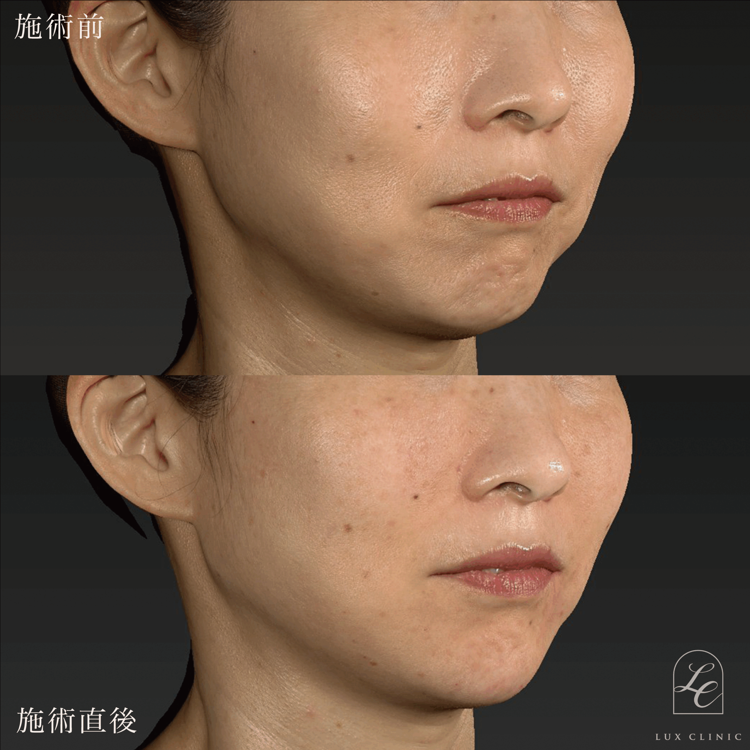 ヒアルロン酸（レスチレン 5本）＜頬、マリオネットライン、顎角、こめかみ＞