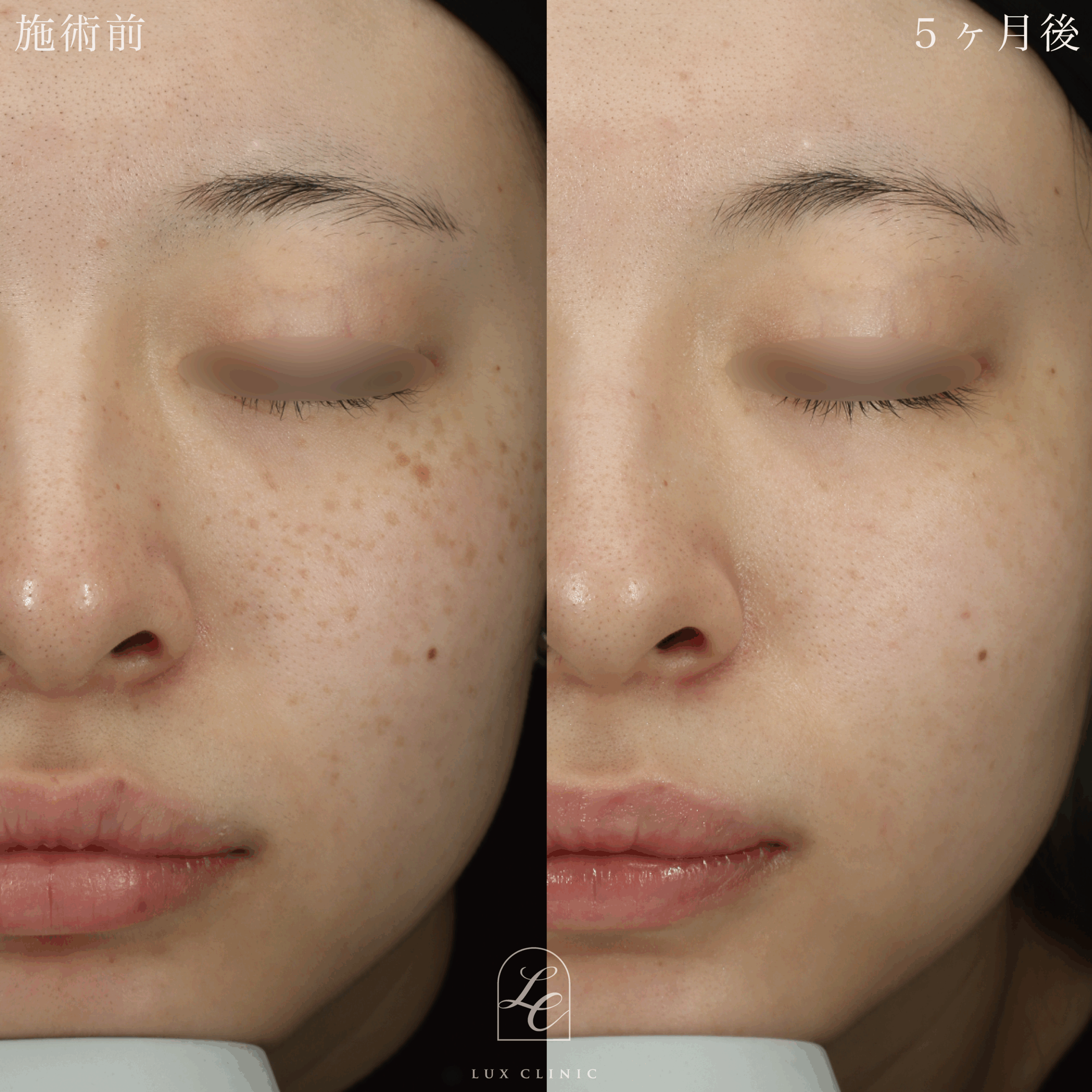 ディスカバリーピコプラス しみスポット照射＜顔全体＞1回