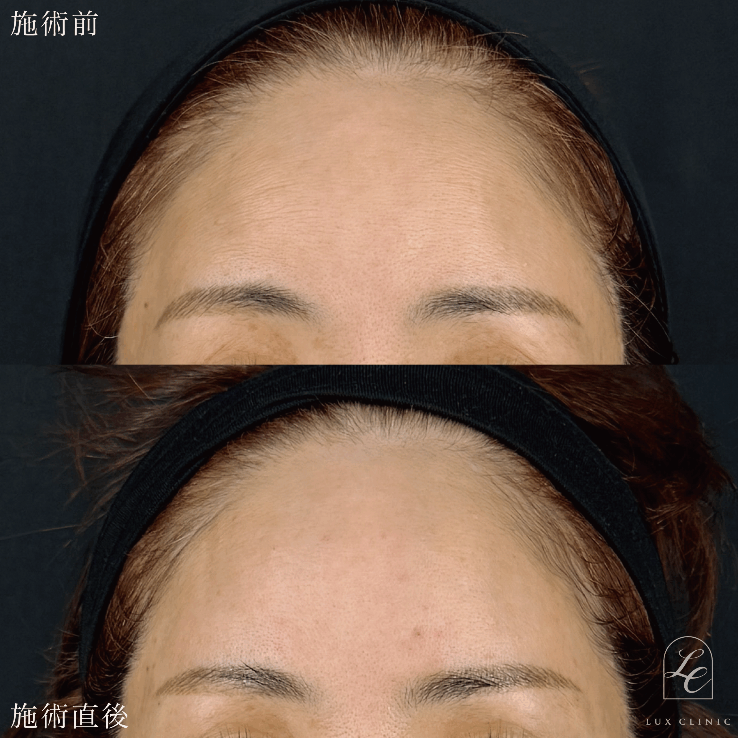 ヒアルロン酸（レスチレン 2本）＜額＞