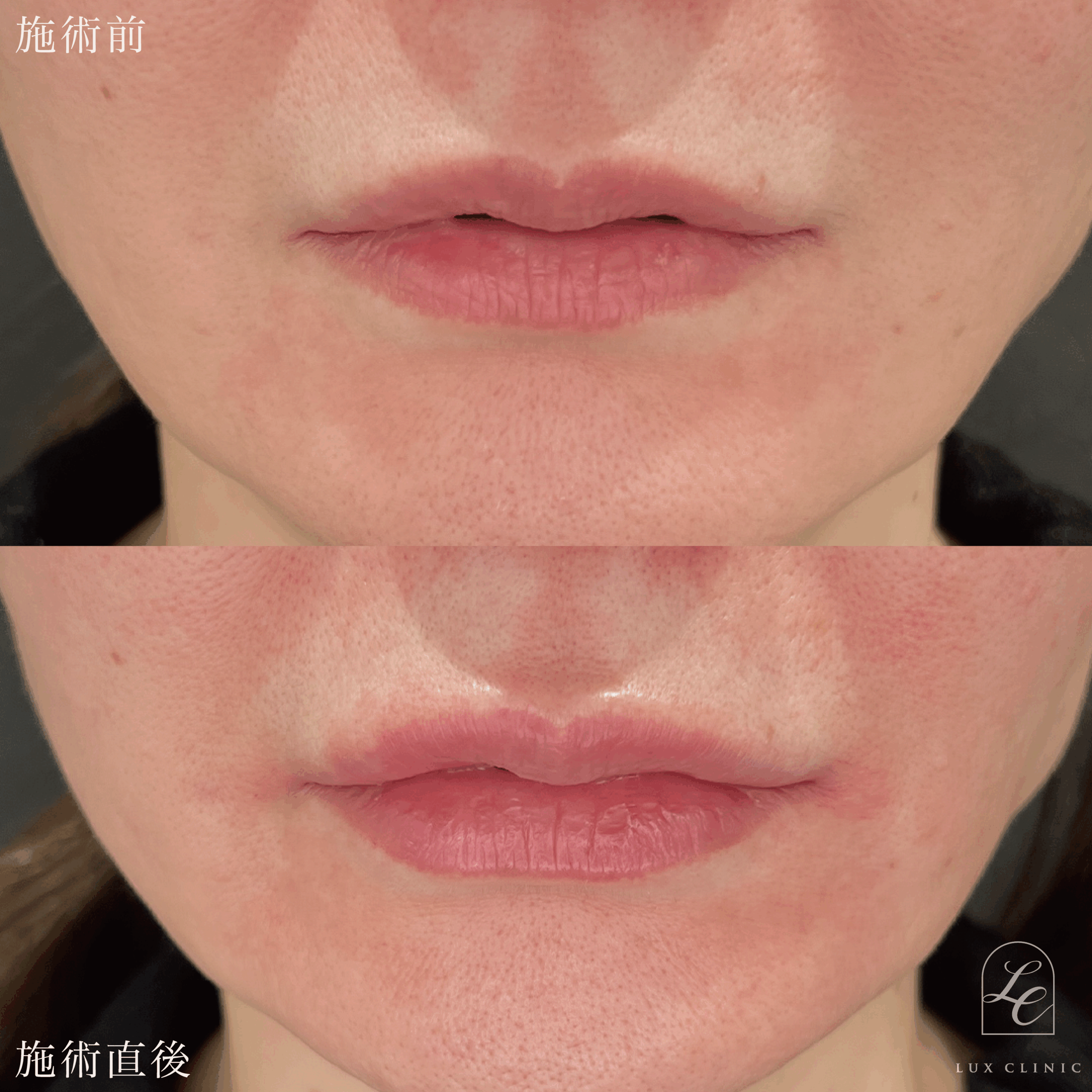 ヒアルロン酸 1本 ＜唇＞