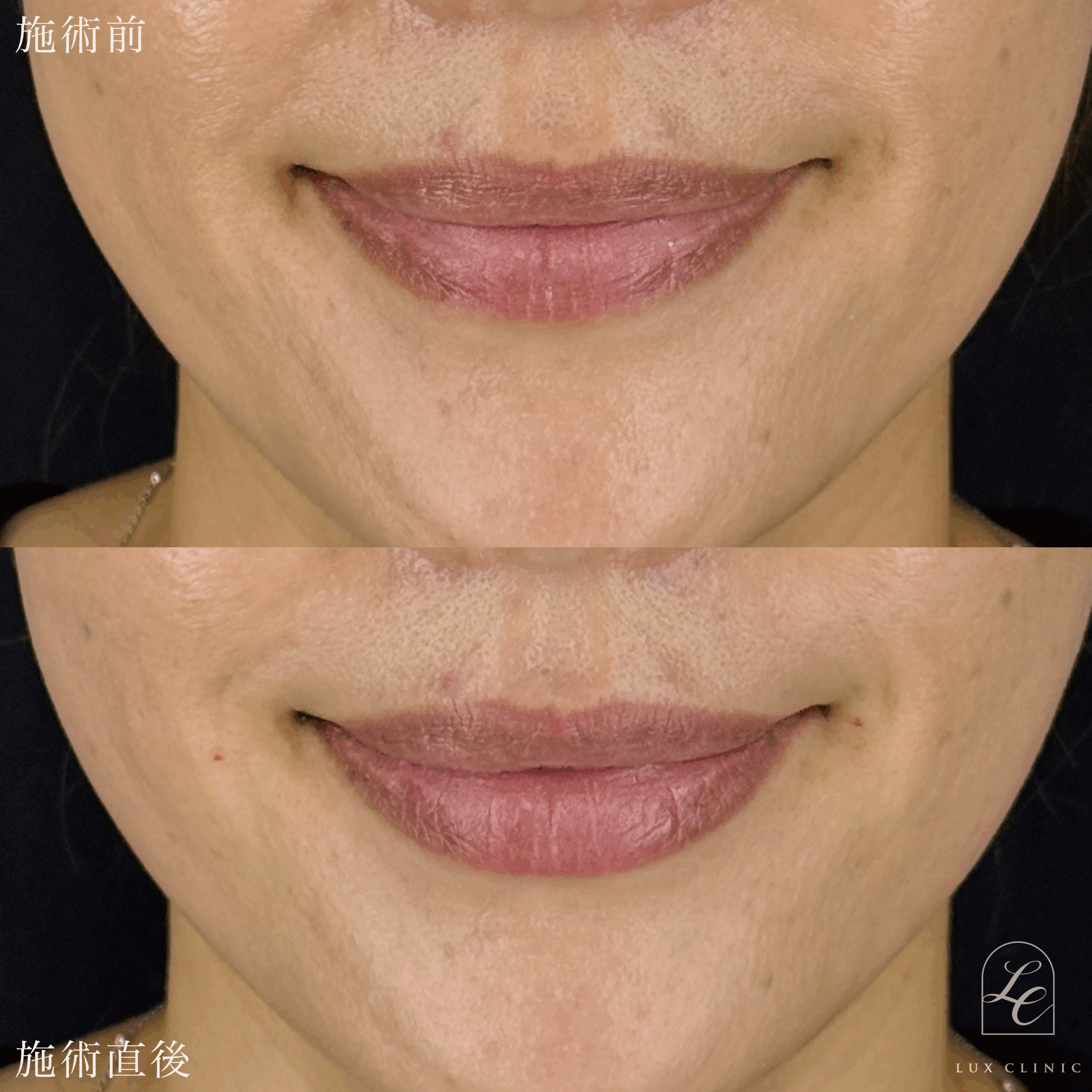 ヒアルロン酸（ニューラミス 1本）＜唇＞