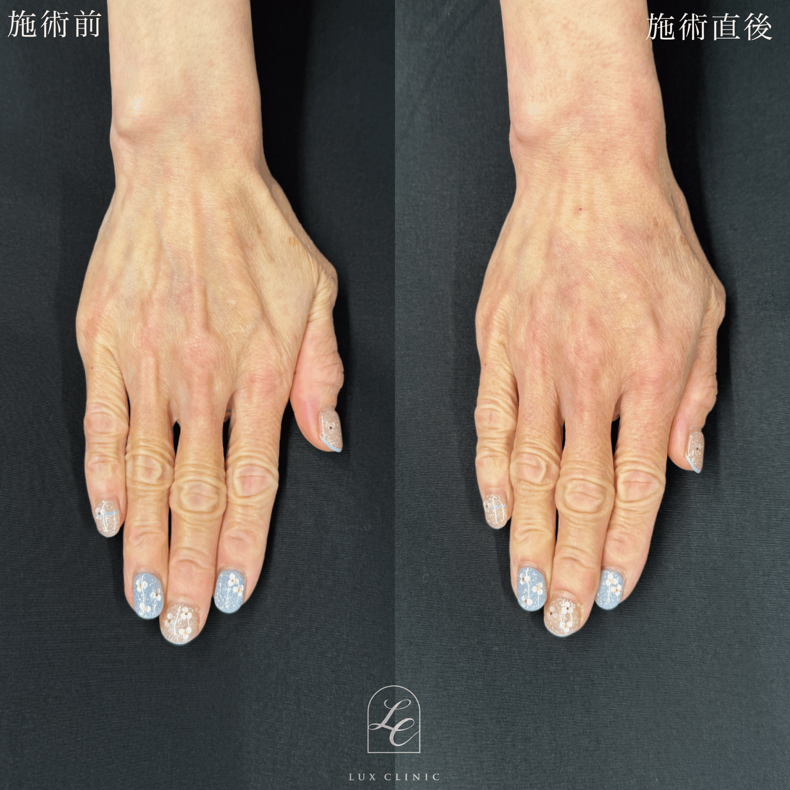 ヒアルロン酸（ジュビダームビスタ 8本 ※片手4本）＜手の甲＞