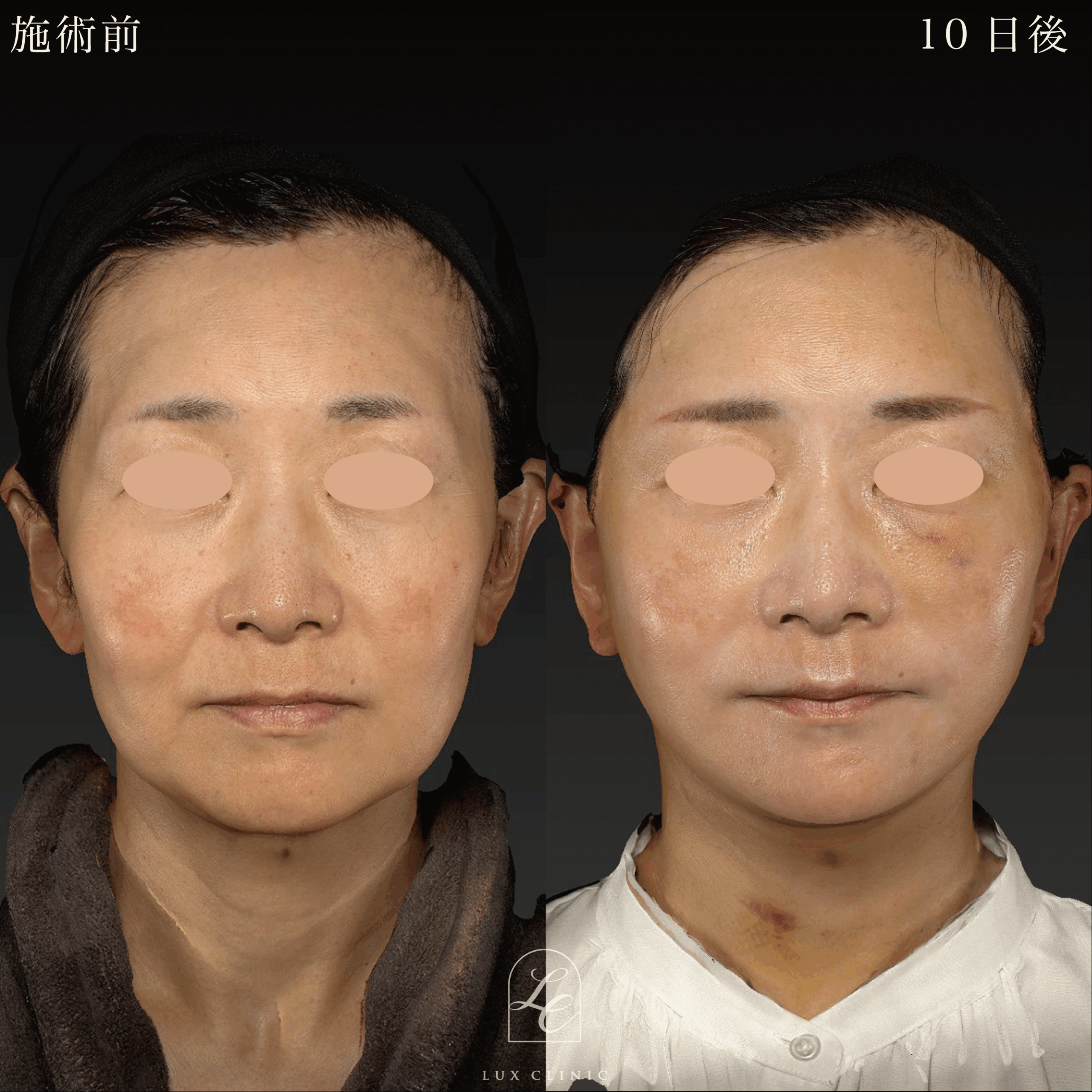 ディーププレーンフェイスネックリフト ＋ もみあげリフト ＋ コンデンスリッチ脂肪注入 ＜顔全体・首＞