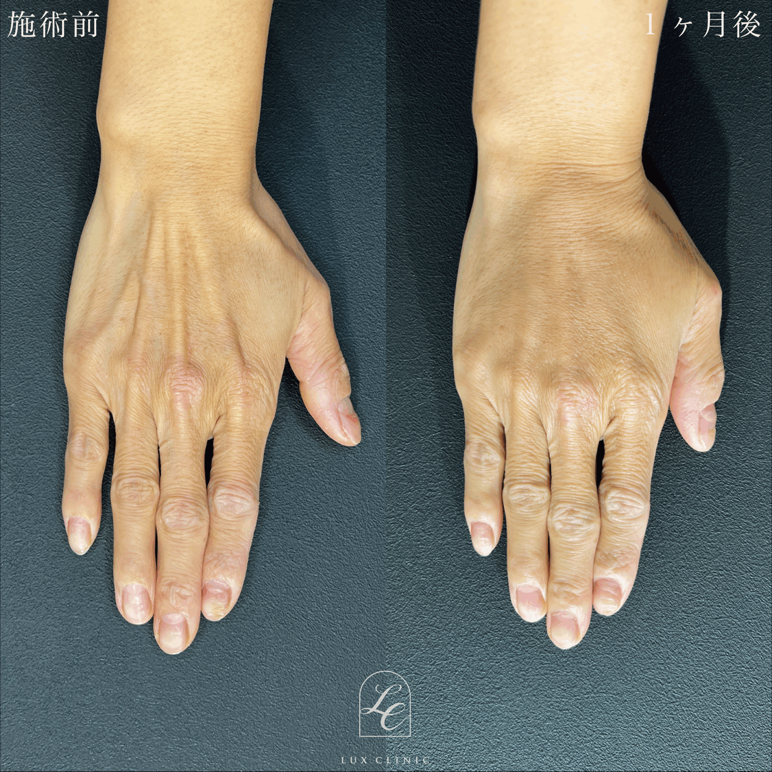 コンデンスリッチ脂肪注入 ＜手の甲＞