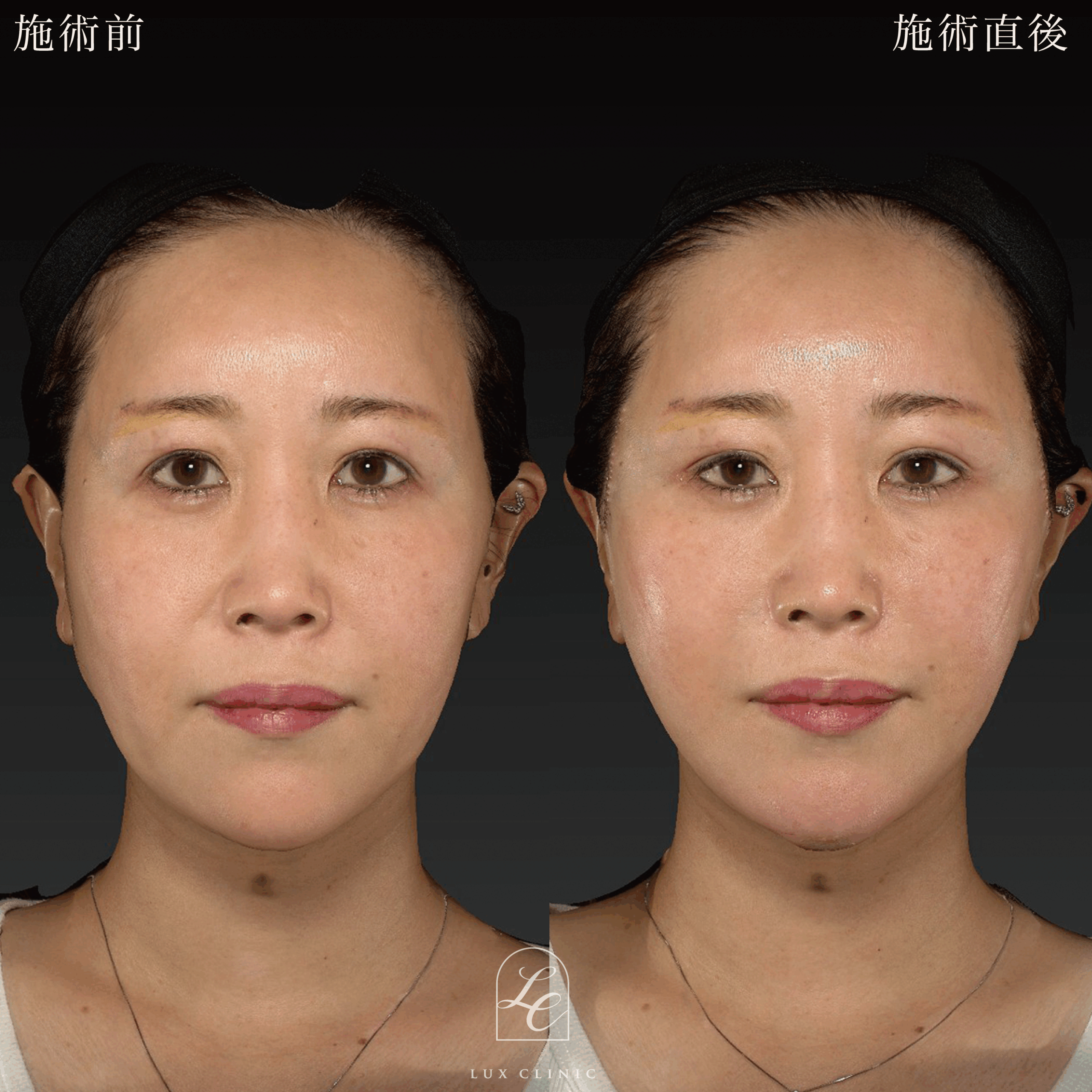 もみあげリフト ＋ ヒアルロン酸（レスチレン2本）＜顔全体ちらし入れ＞