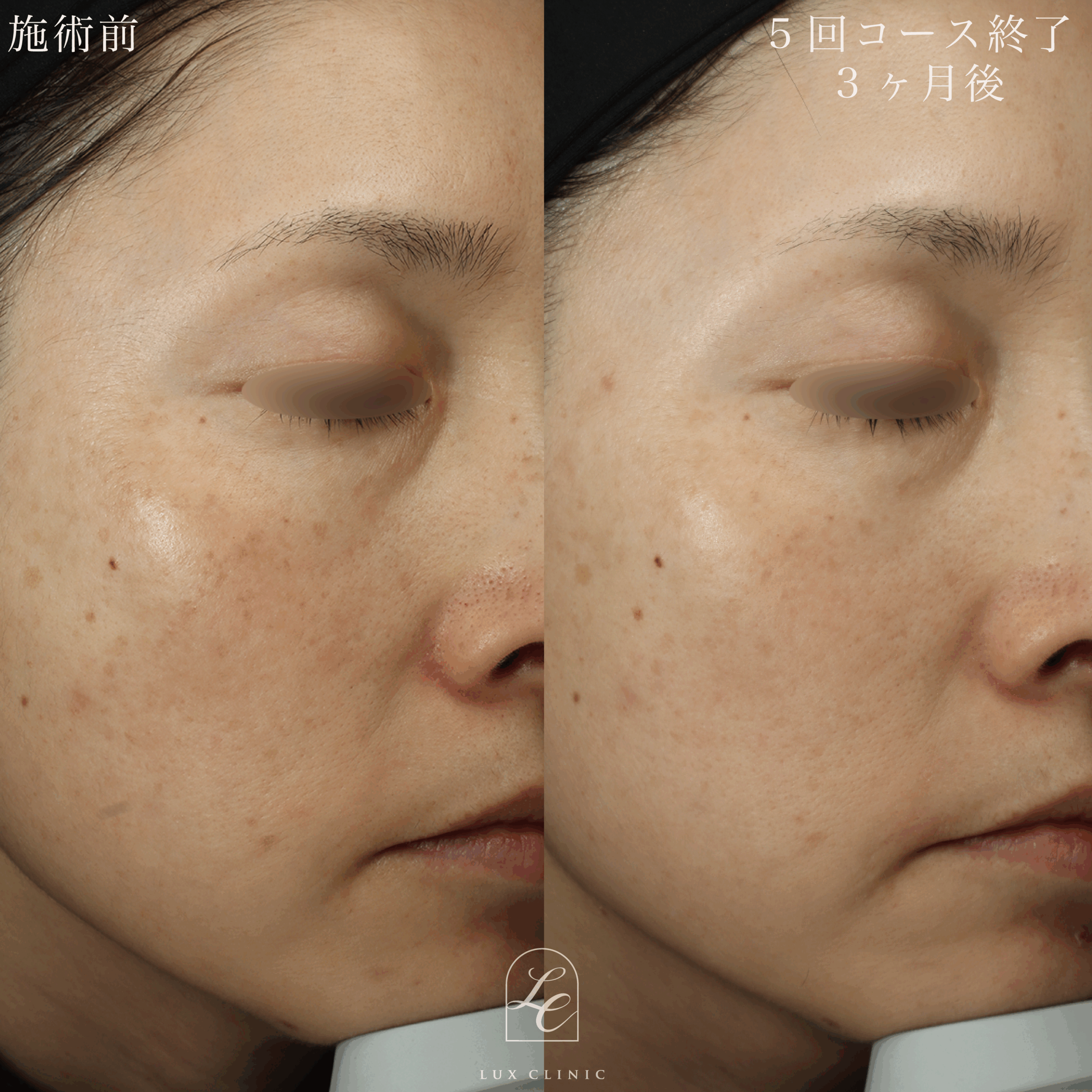 ディスカバリーピコプラス ピコトーニング 5回