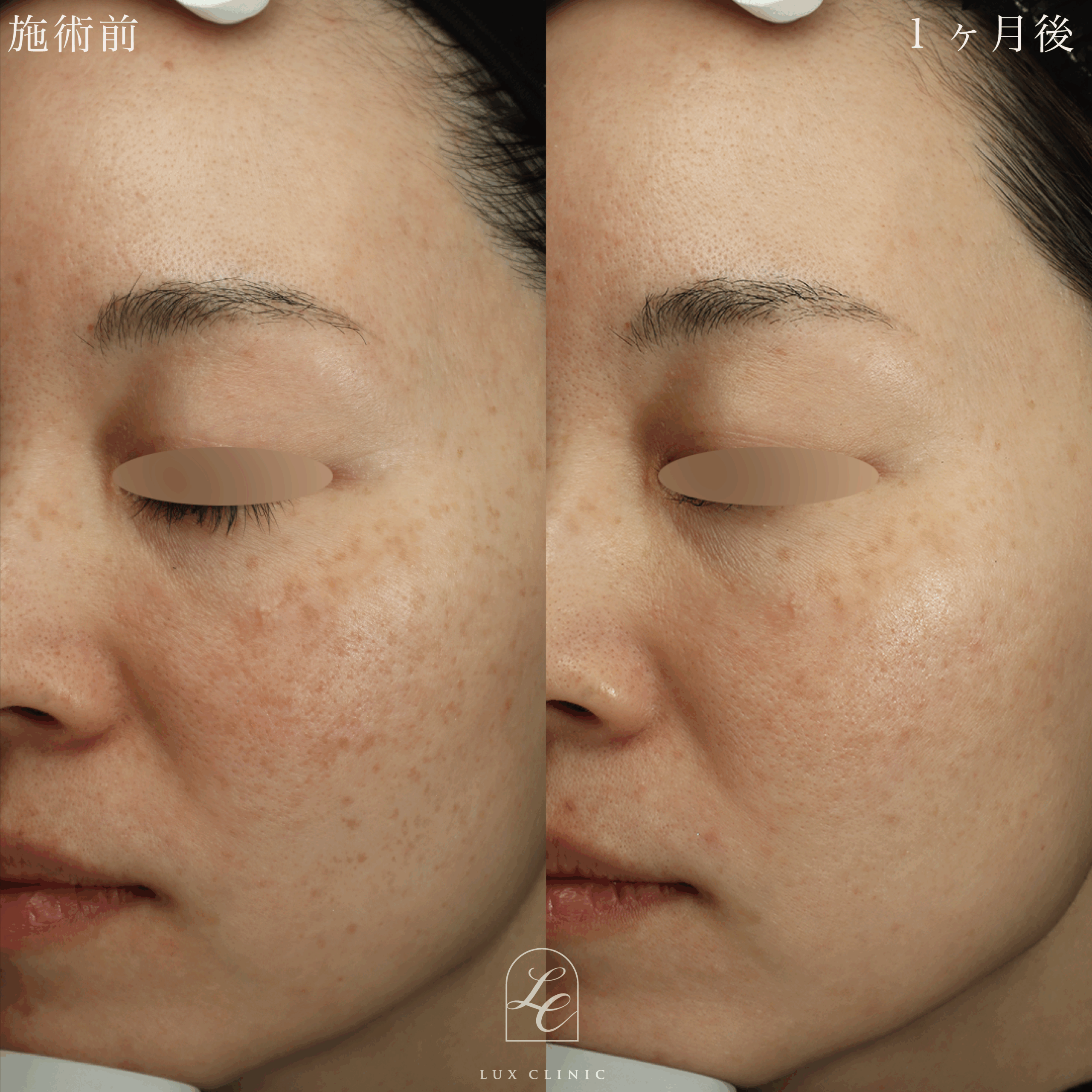 光治療IPL ルメッカ 1回