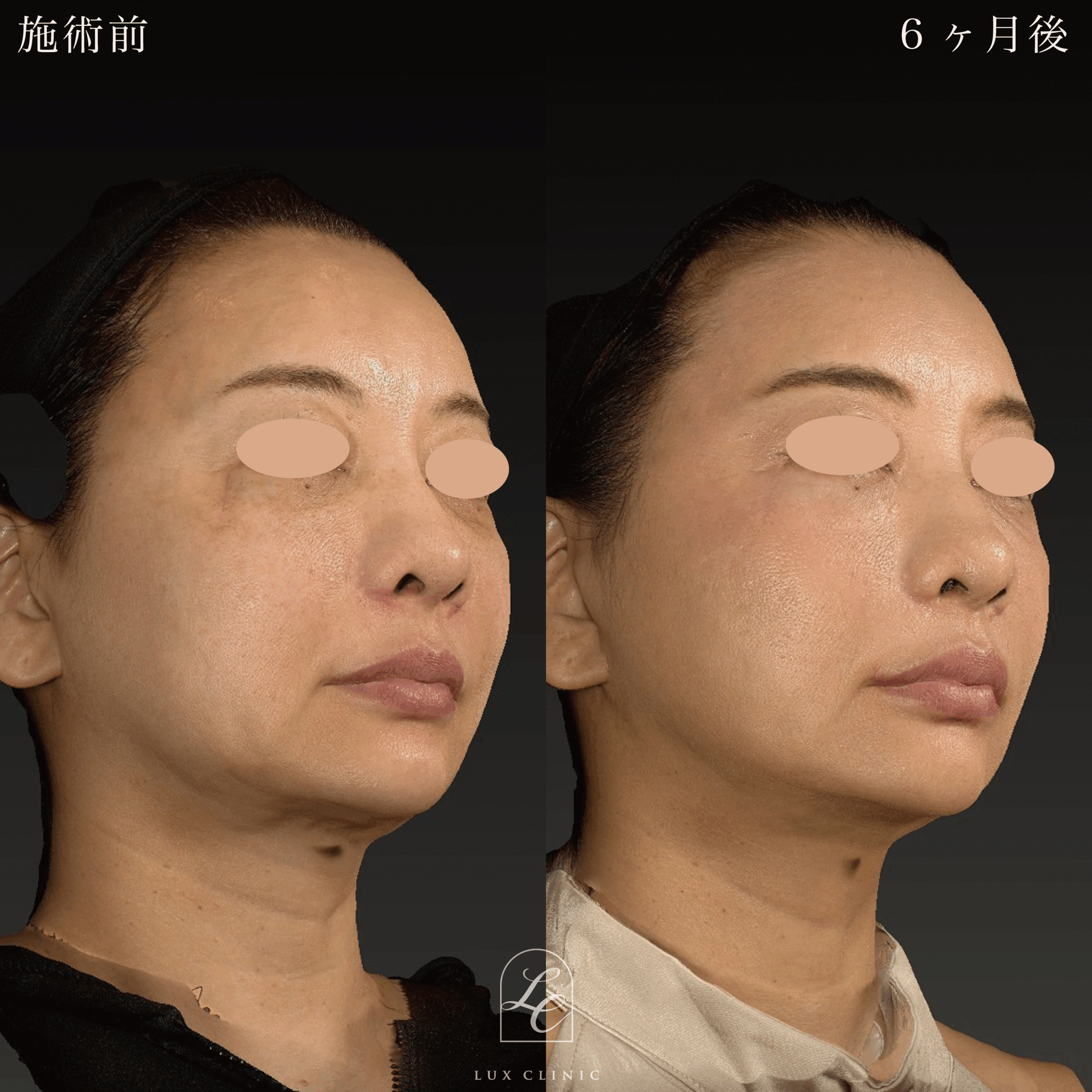 ミニフェイスリフト ＋ 糸リフト 10本