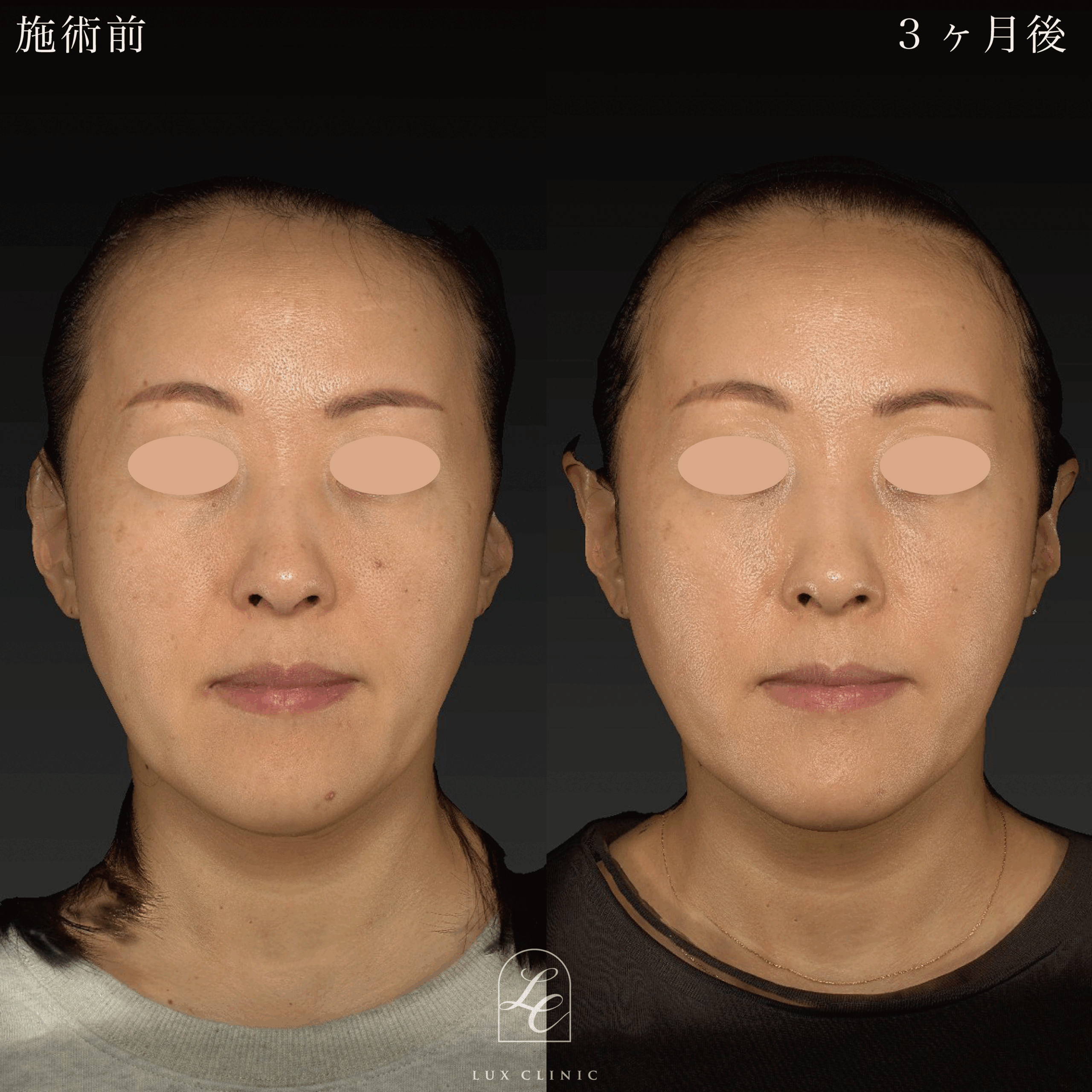 もみあげリフト