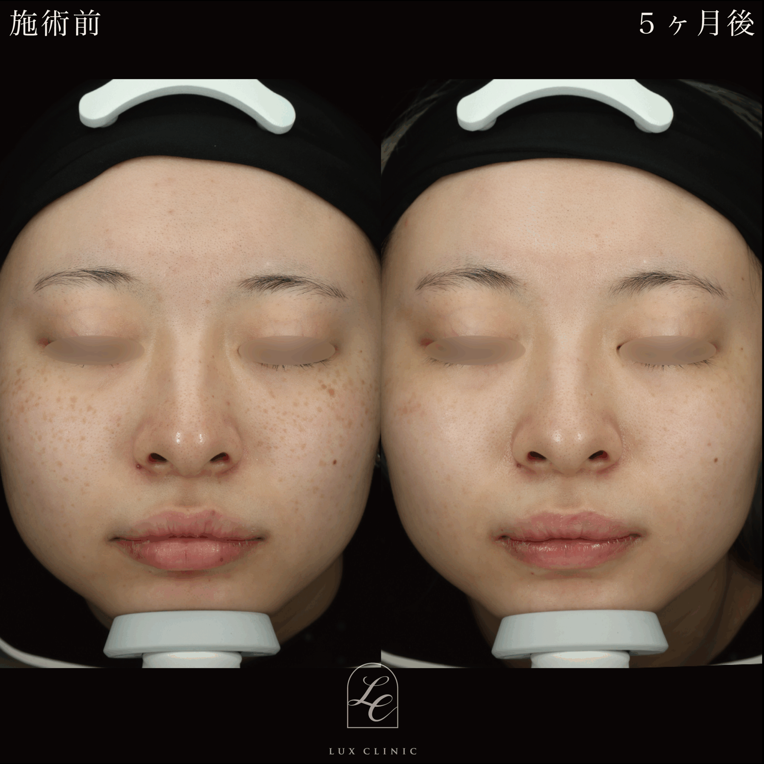 ディスカバリーピコプラス しみスポット照射＜顔全体＞1回