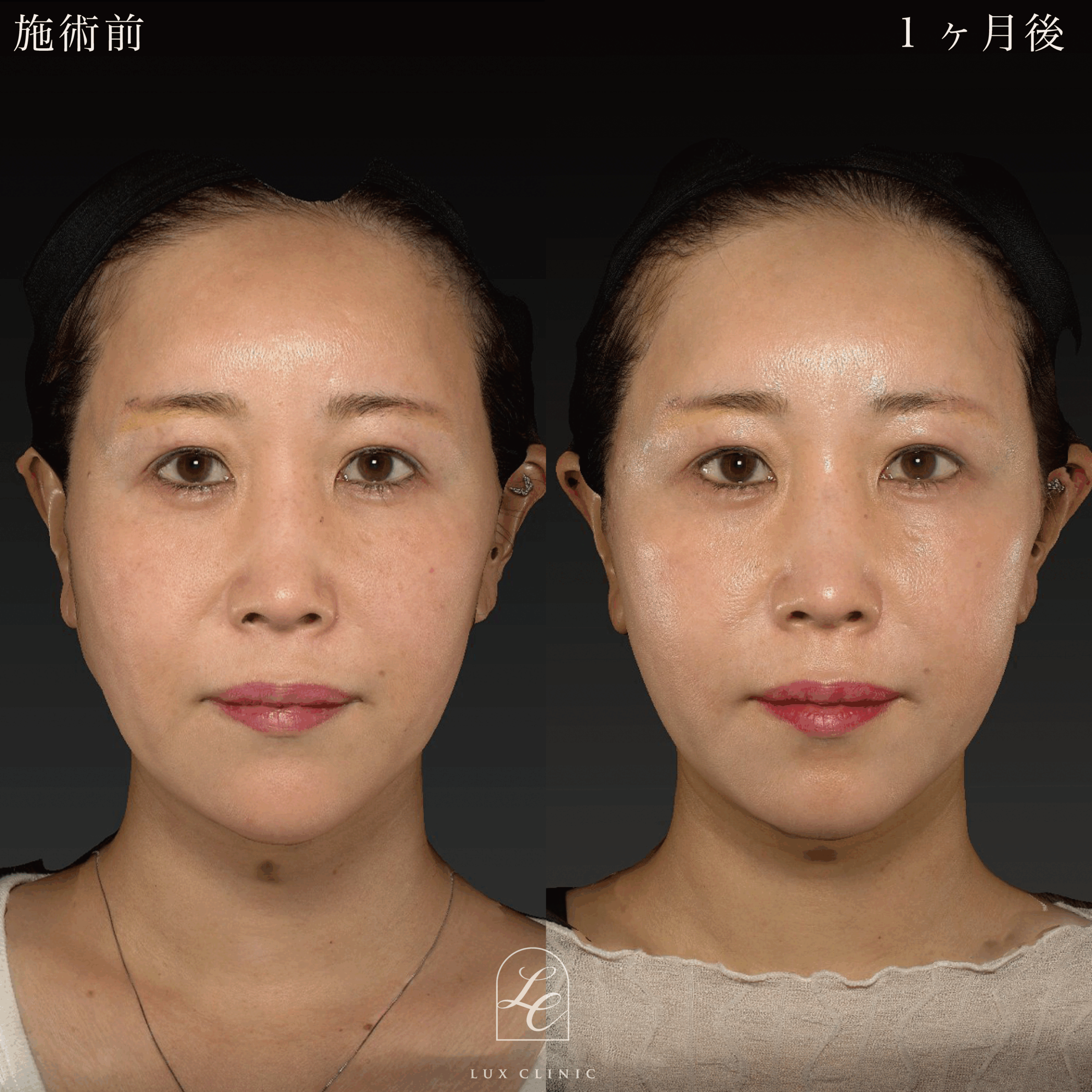 もみあげリフト ＋ ヒアルロン酸（レスチレン2本）＜顔全体ちらし入れ＞※顔出しモニター