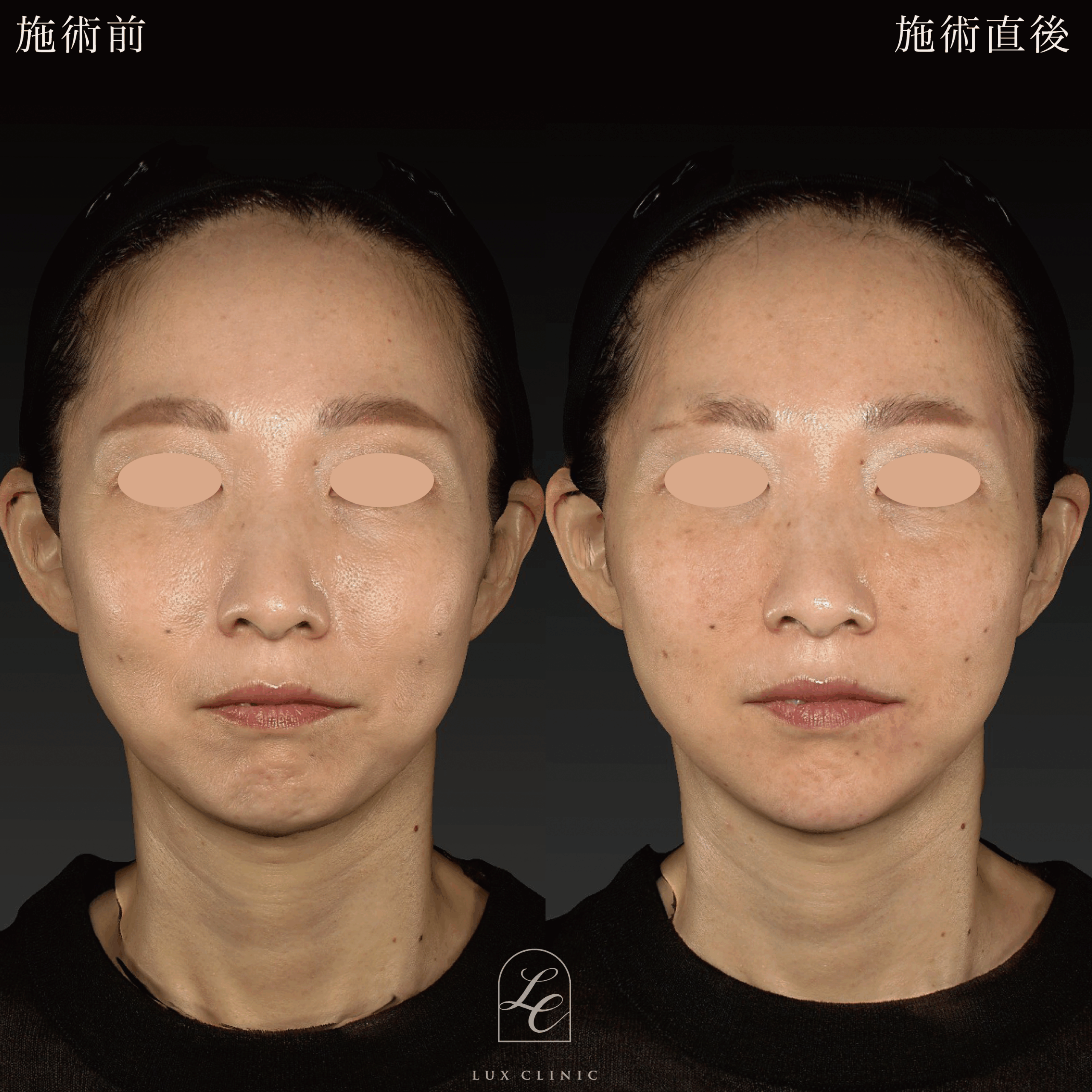 ヒアルロン酸（レスチレン 5本）＜頬、マリオネットライン、顎角、こめかみ＞