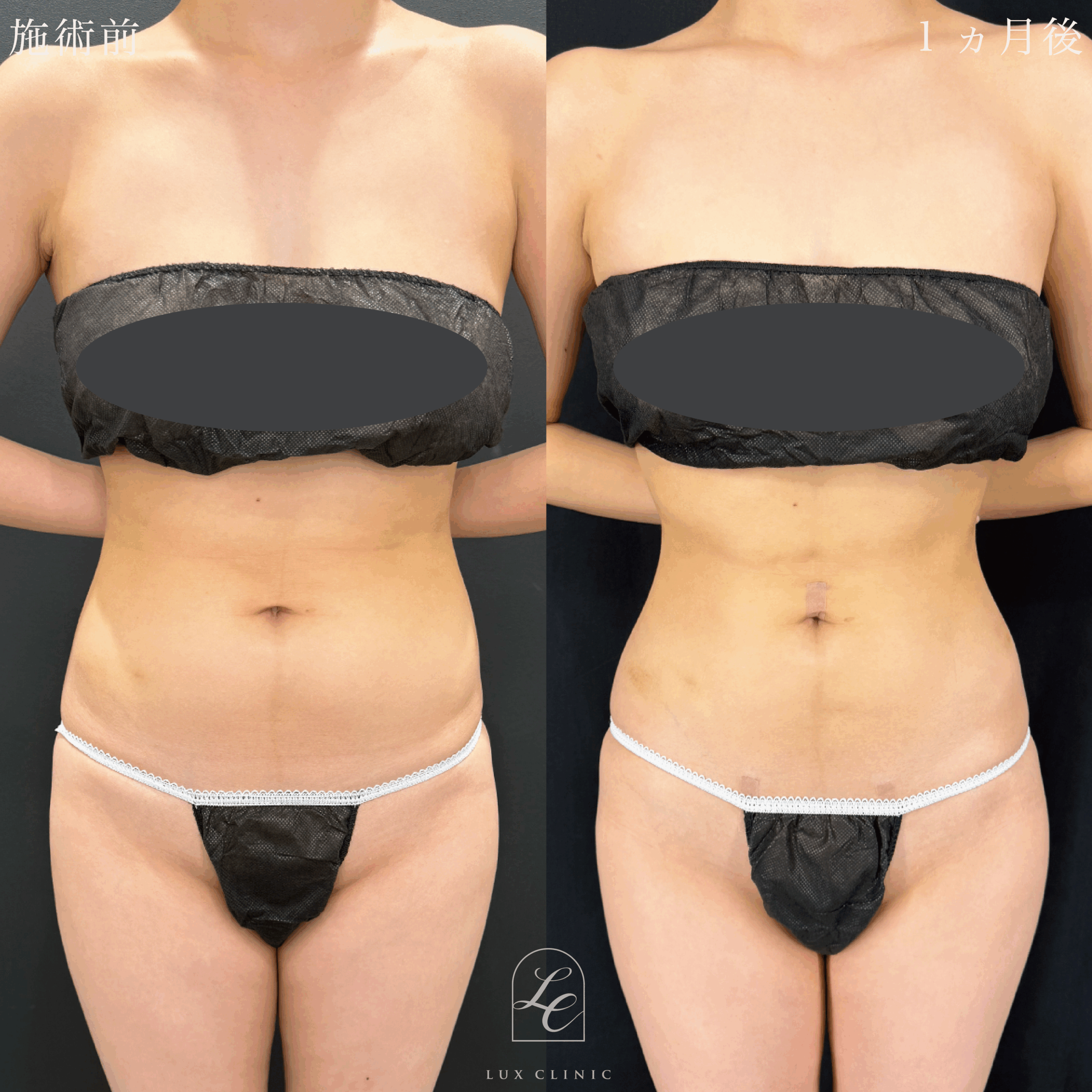 Ultra-Z 脂肪吸引 <腹部全面(上・下)・脇腹(前・後)・腰>