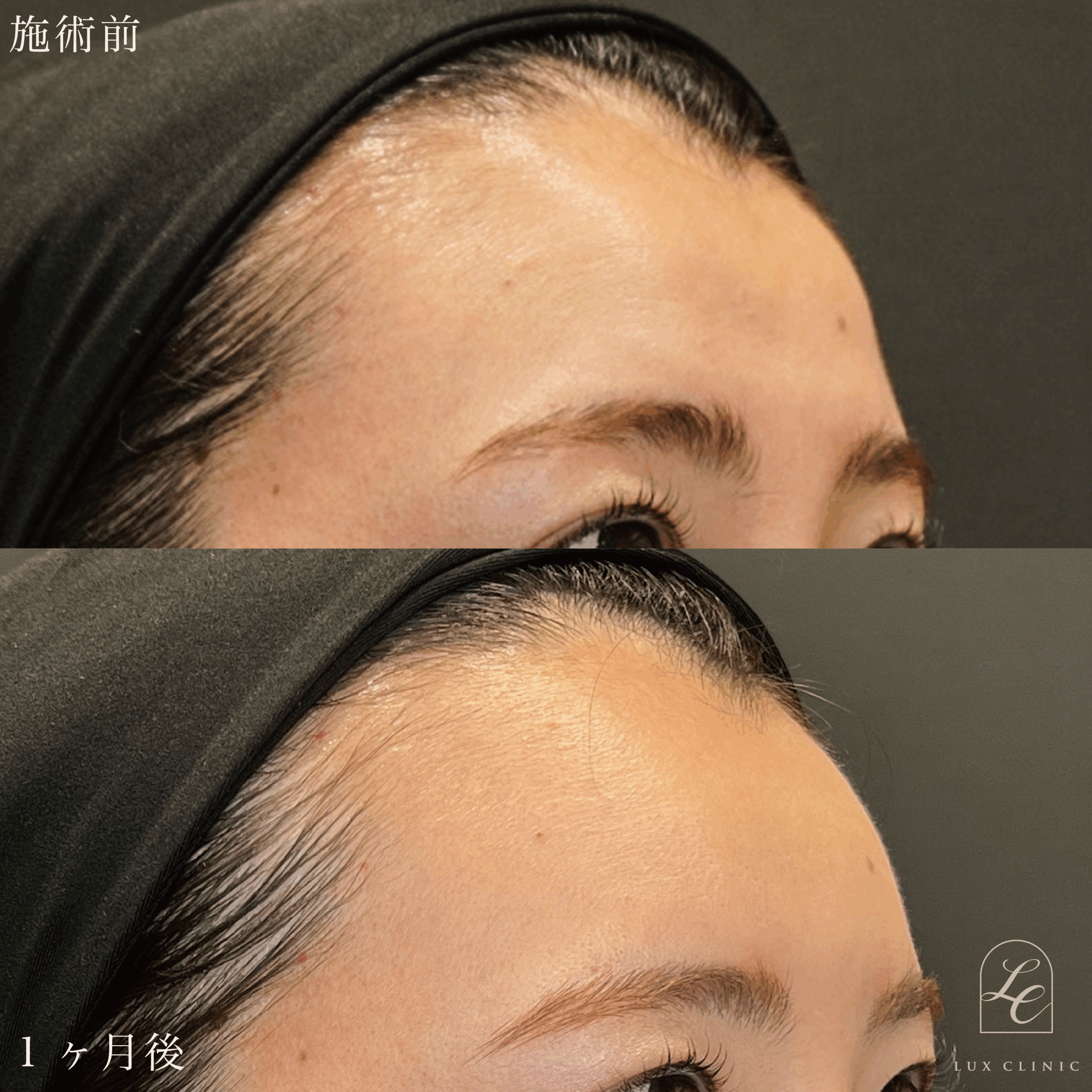 エランセM 3本 ＜額＞