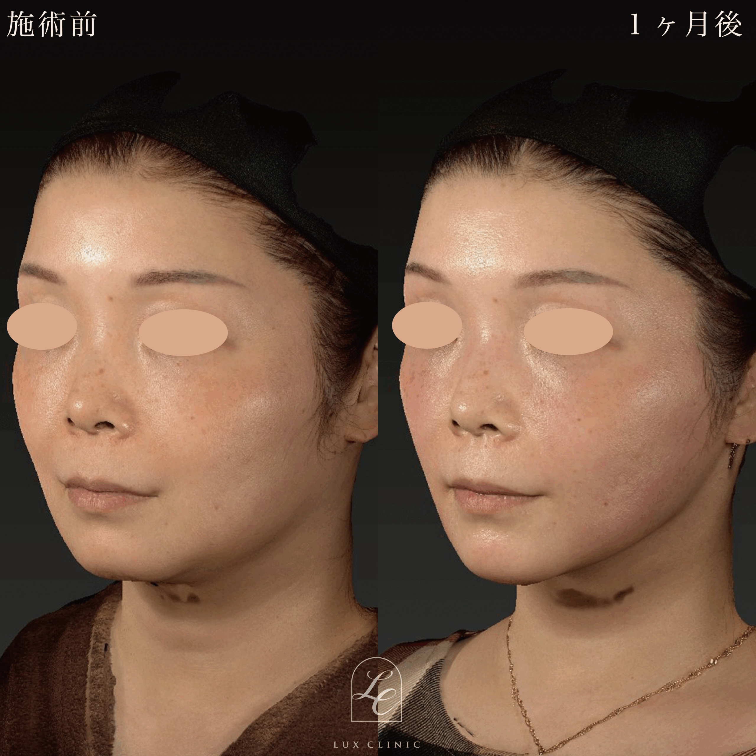 ミニフェイスリフト ＋ Ultra-Z 脂肪吸引＜あご下＞ ＋ 糸リフト（BNLS Ultimate Lifting 2本）＜あご下＞ ＋ ヒアルロン酸（レスチレン2本）＜あご、口横、鼻翼基部＞