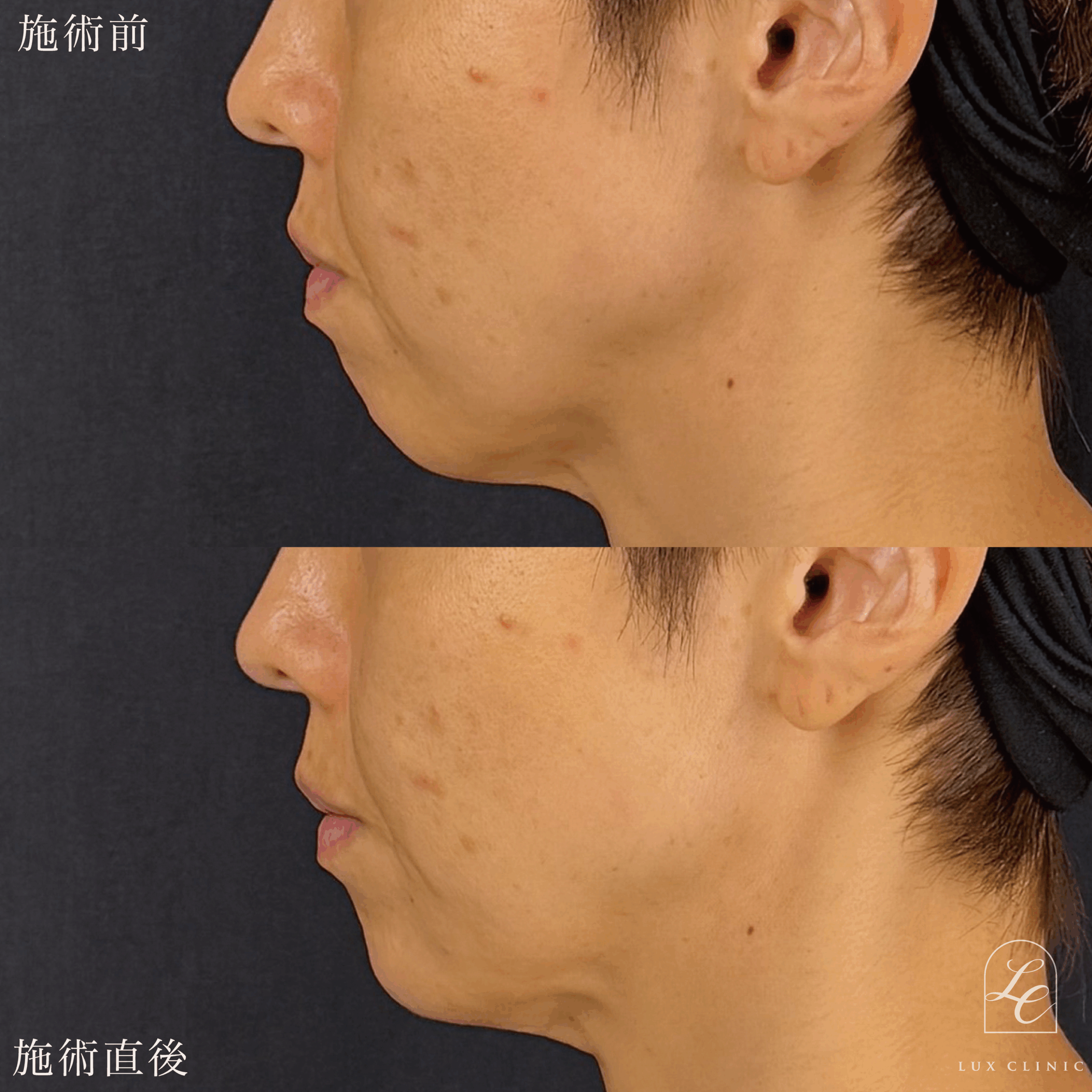 ヒアルロン酸（レスチレン 3本）＜あご、口横、鼻翼基部＞