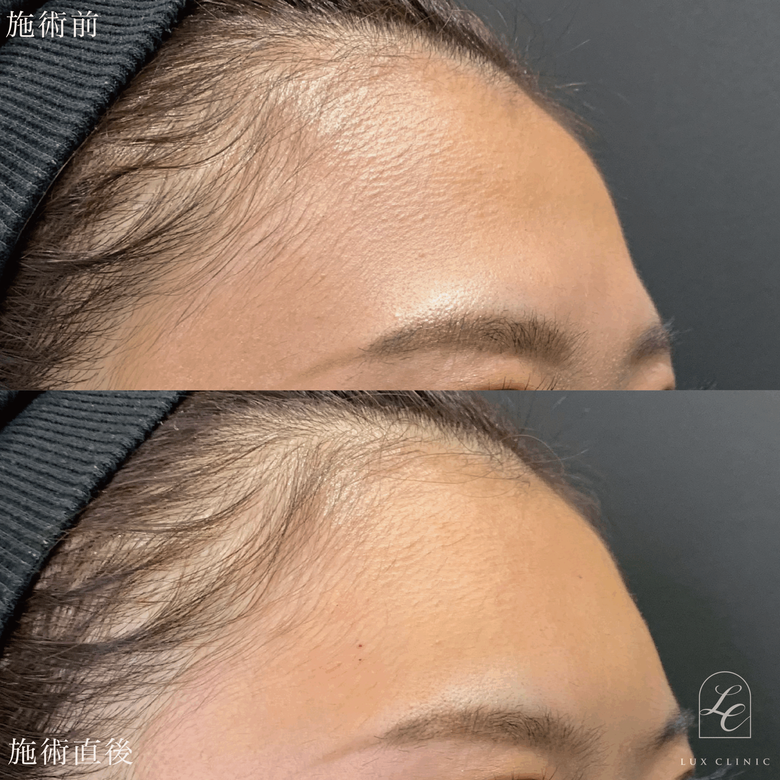 エランセM ２本 ＜額＞