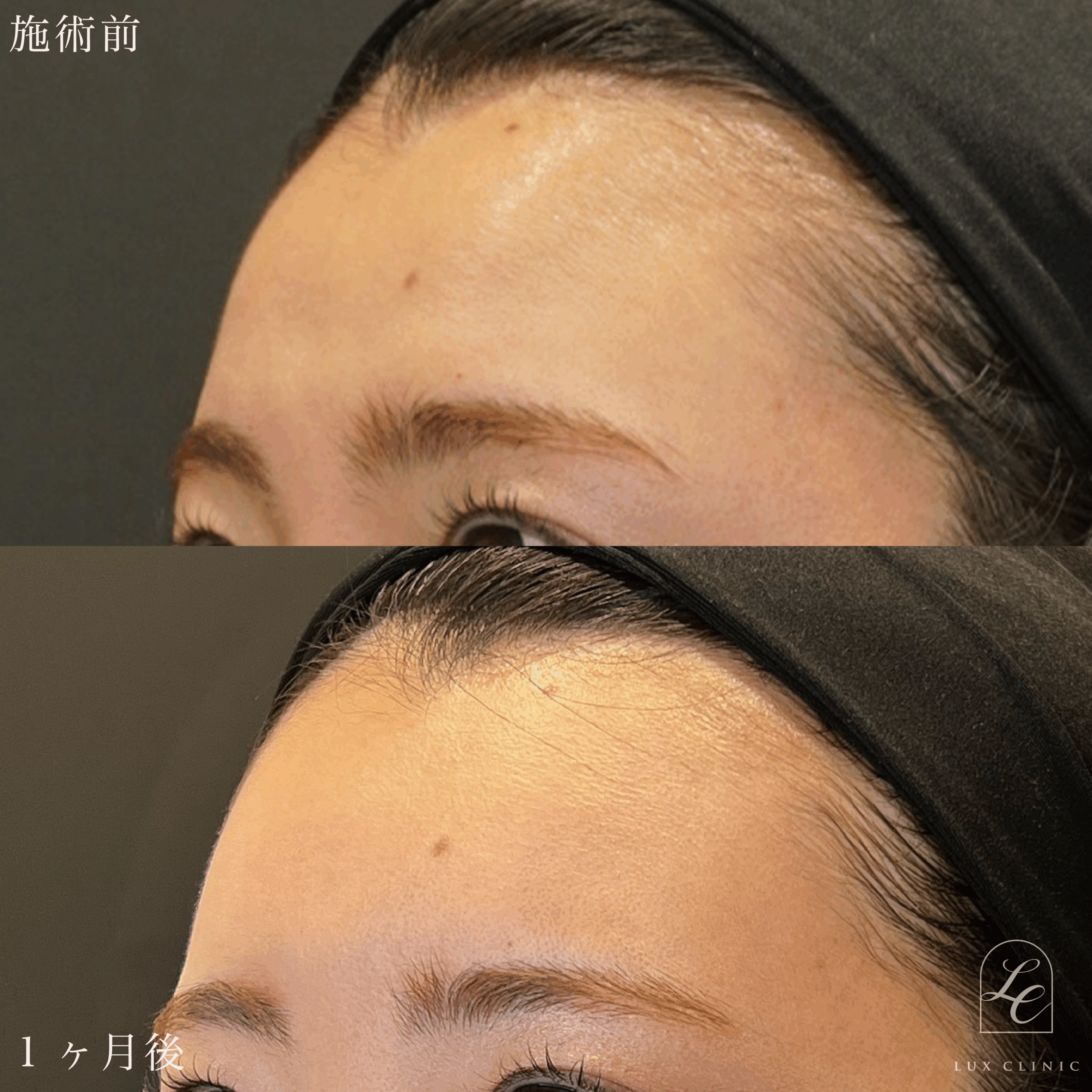 エランセM 3本 ＜額＞