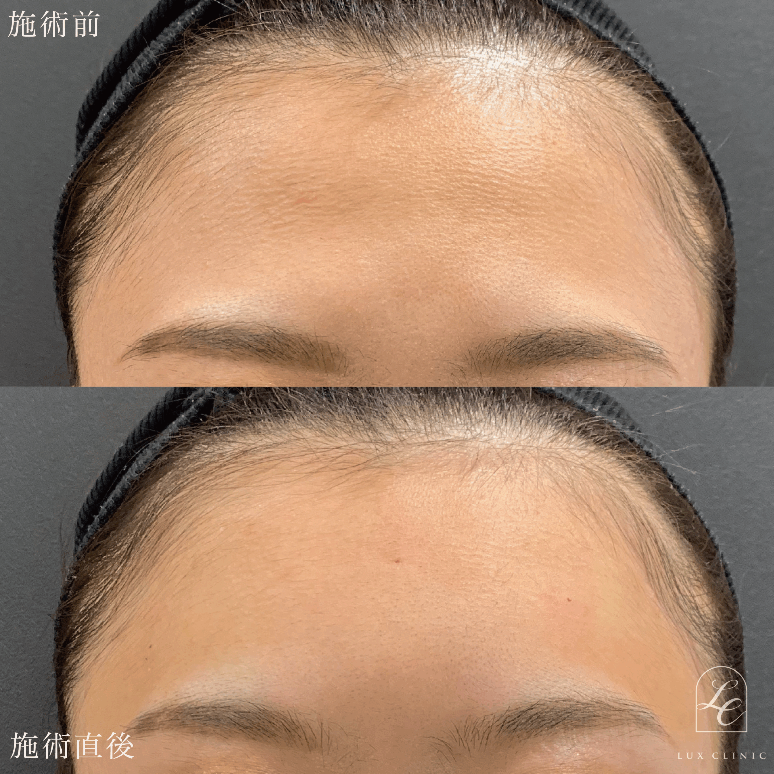 エランセM ２本 ＜額＞