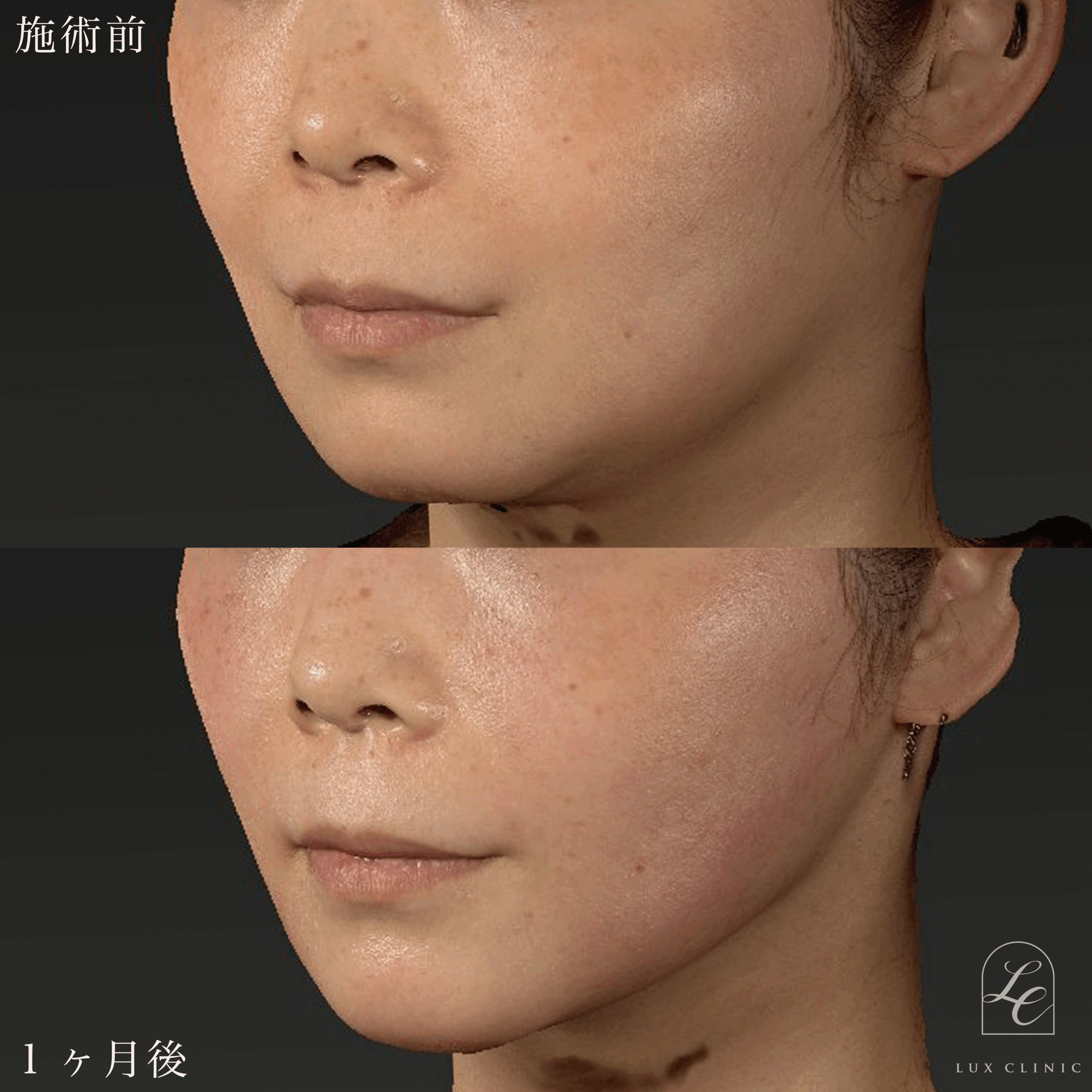 ミニフェイスリフト ＋ Ultra-Z 脂肪吸引＜あご下＞ ＋ 糸リフト（BNLS Ultimate Lifting 2本）＜あご下＞ ＋ ヒアルロン酸（レスチレン2本）＜あご、口横、鼻翼基部＞