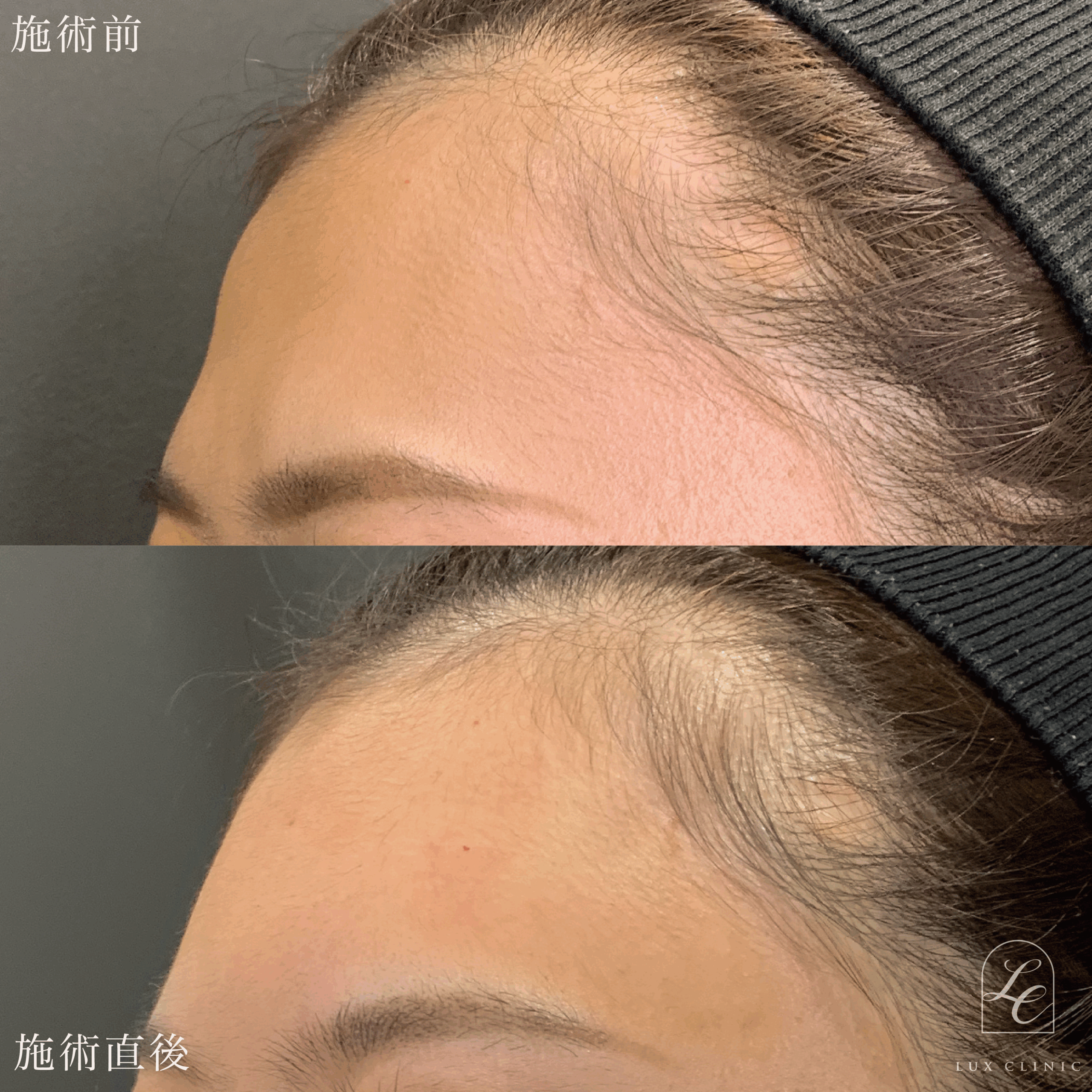 エランセM ２本 ＜額＞