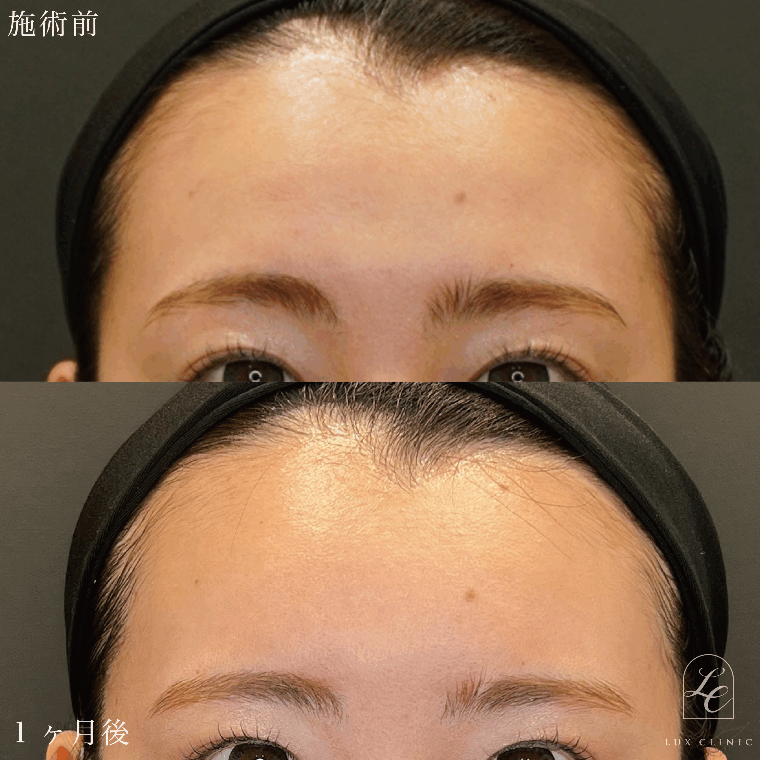 エランセM 3本 ＜額＞