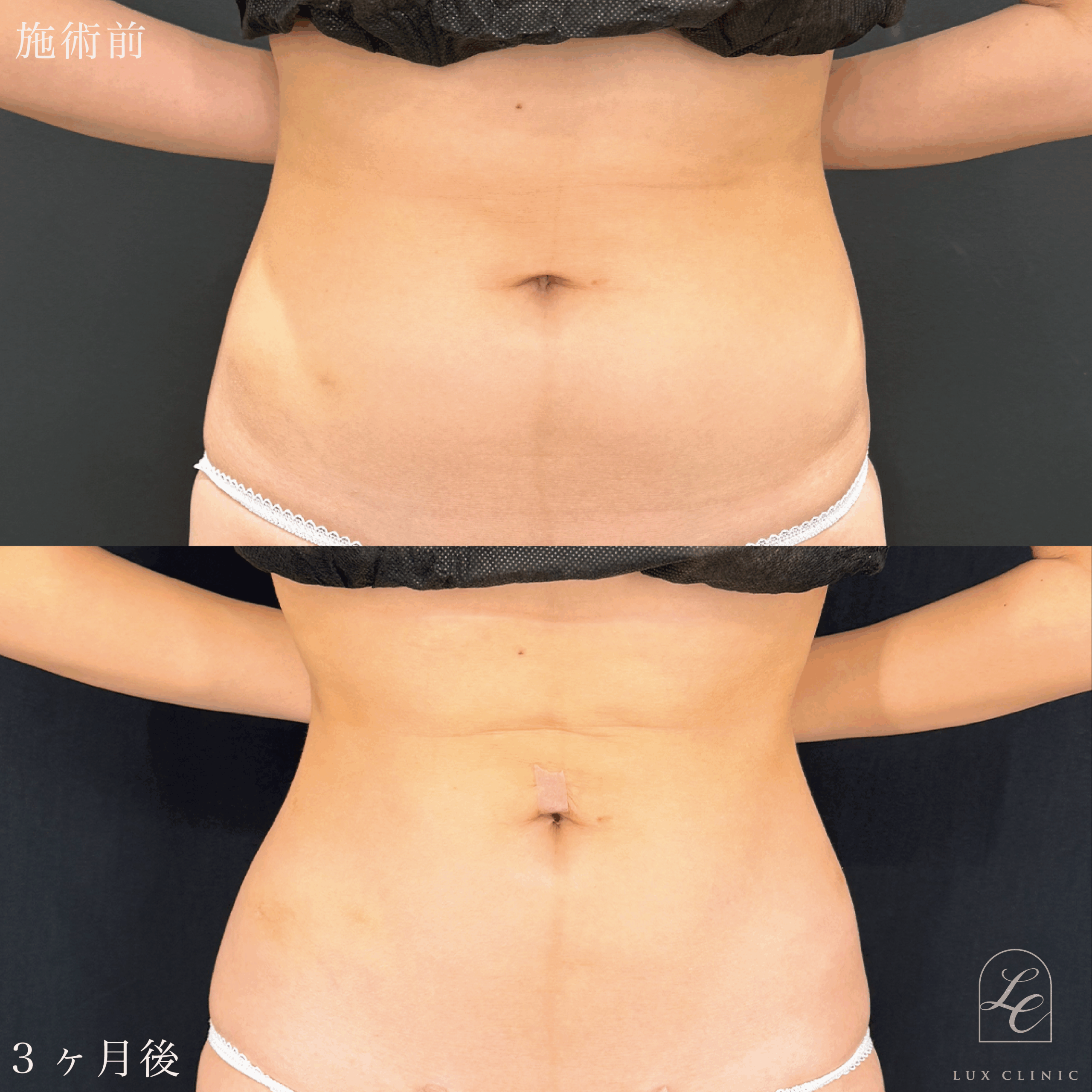 Ultra-Z 脂肪吸引 ＜腹部全面（上・下）・脇腹（前・後）・腰＞