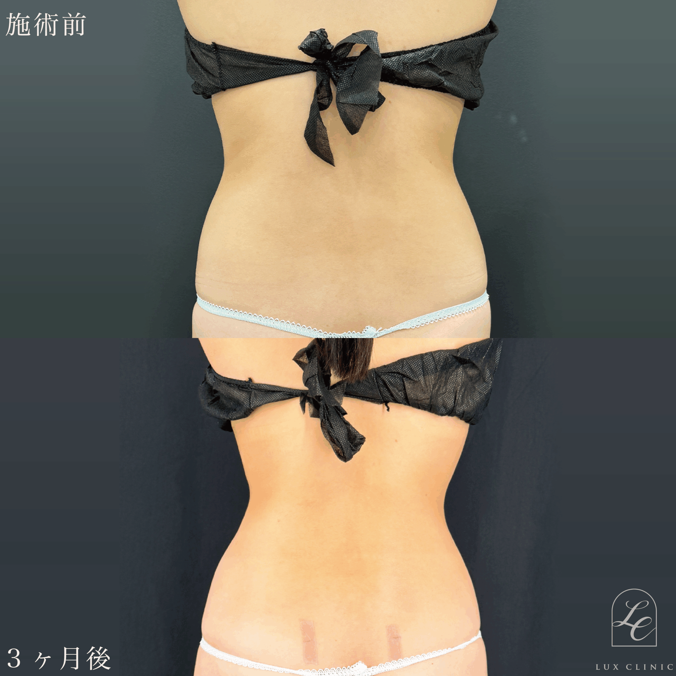 Ultra-Z 脂肪吸引 ＜腹部全面（上・下）・脇腹（前・後）・腰＞